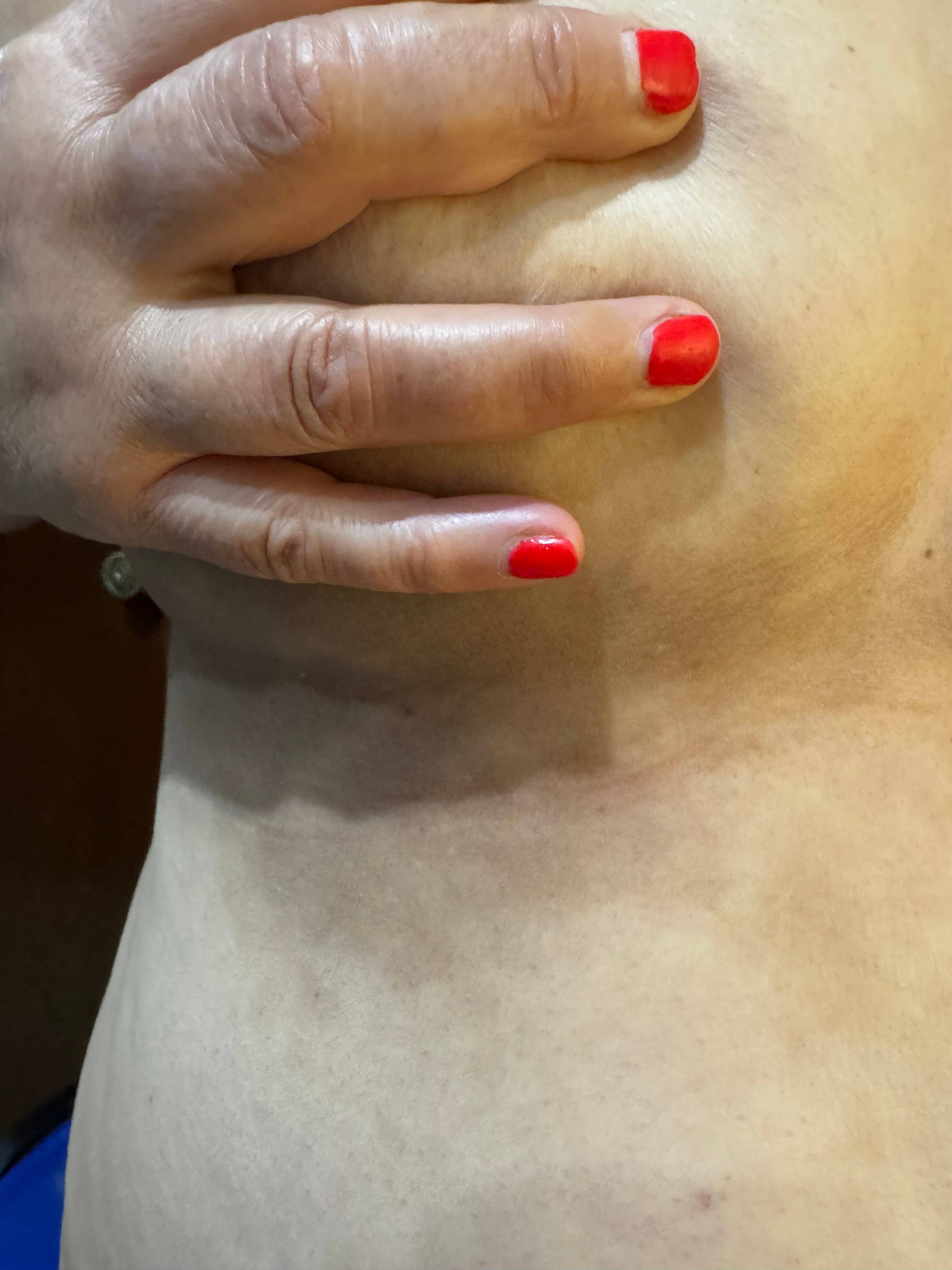 DERMATOSIS CENICIENTA