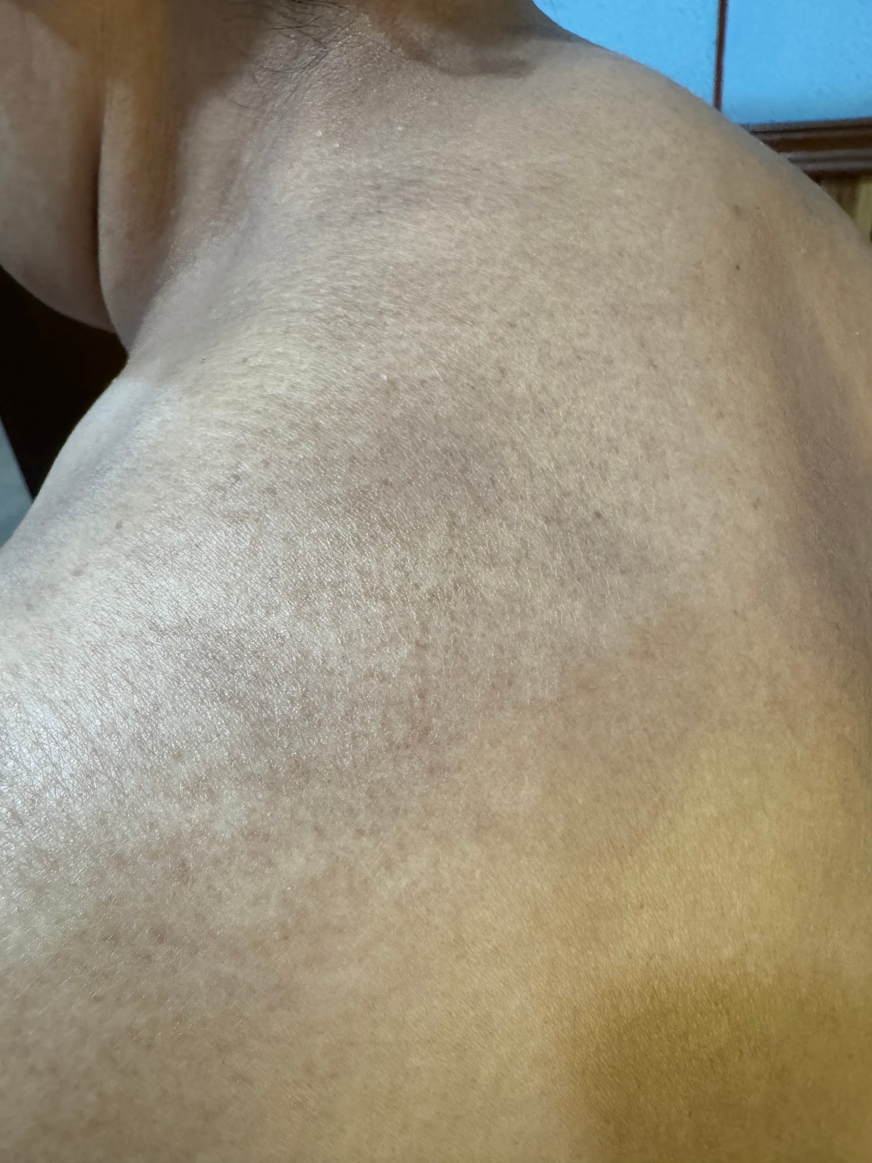 DERMATOSIS CENICIENTA