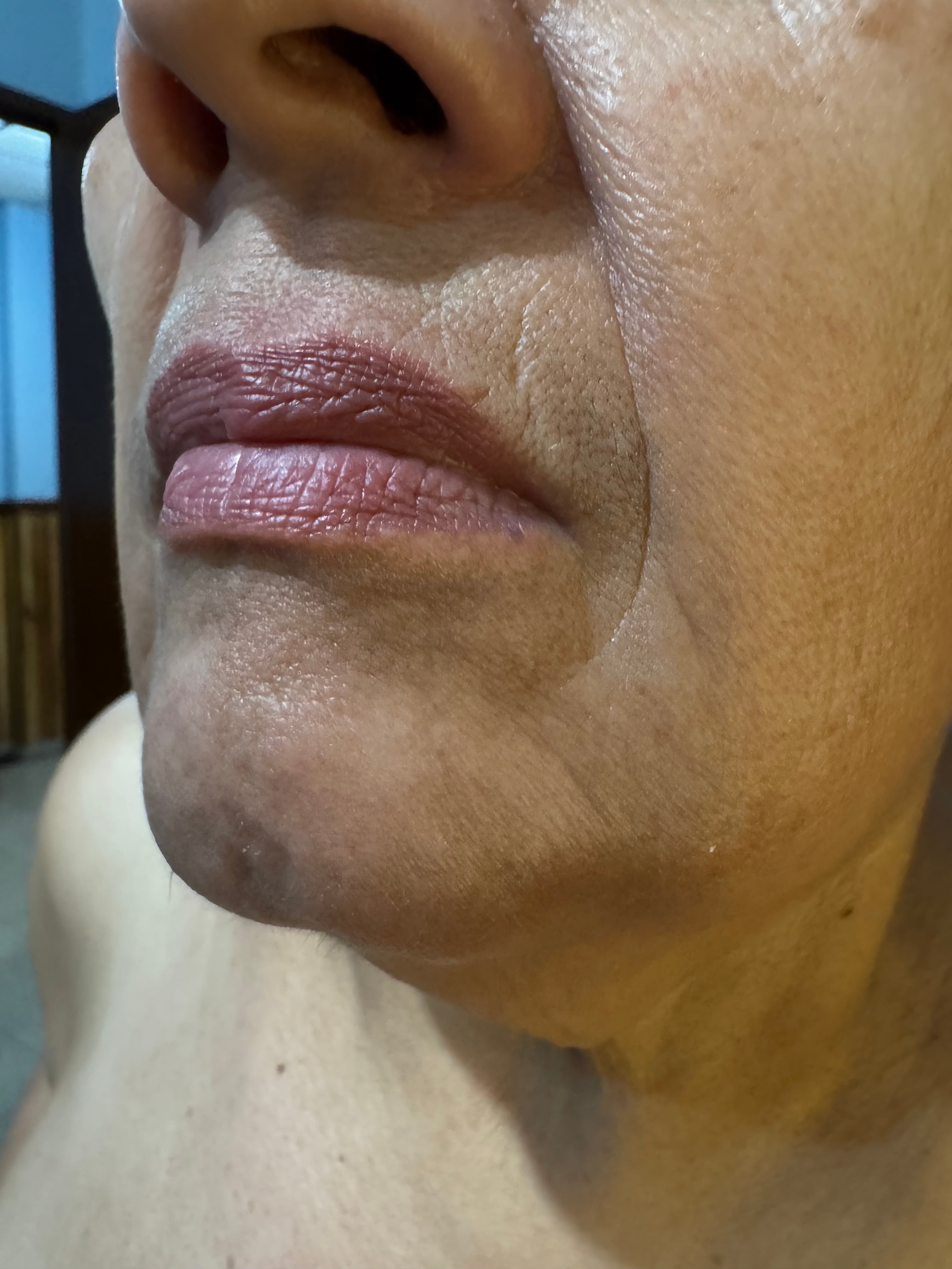 DERMATOSIS CENICIENTA