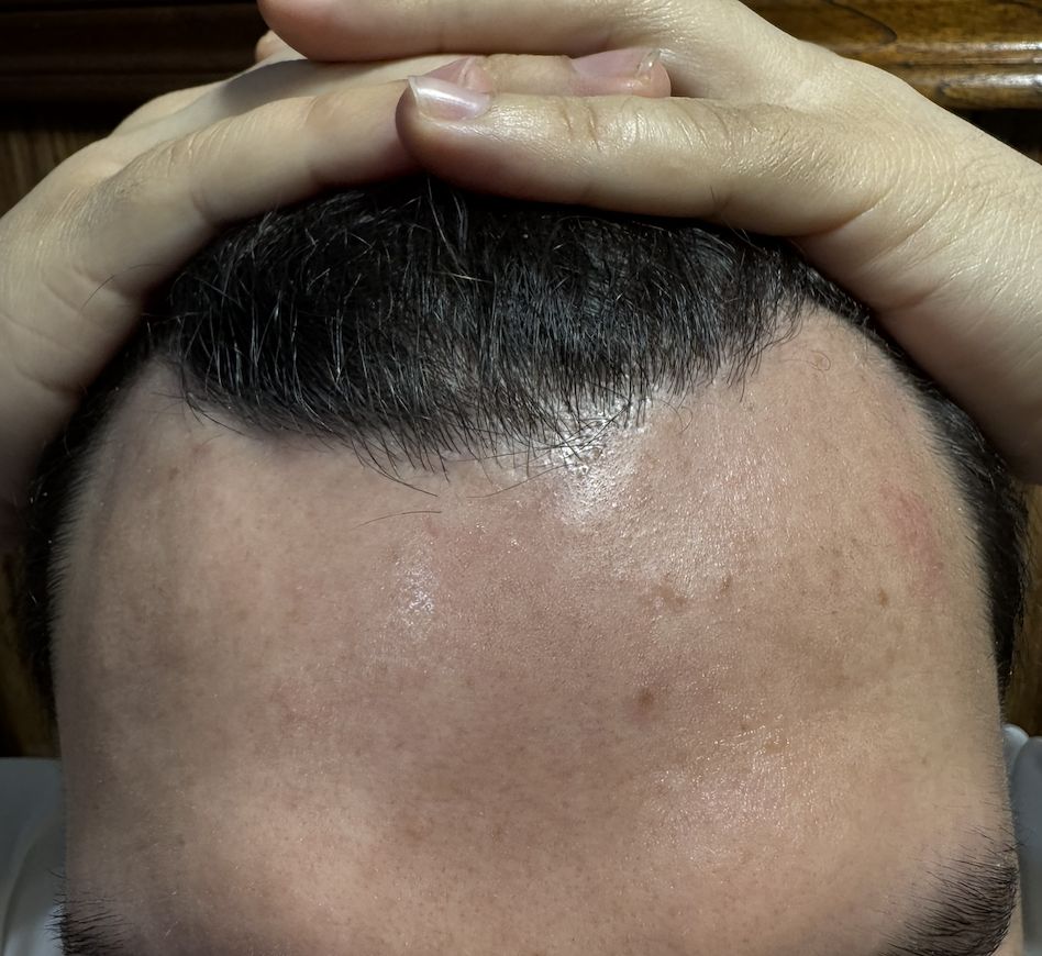 ALOPECIA ANDROGENETICA Patron masculino