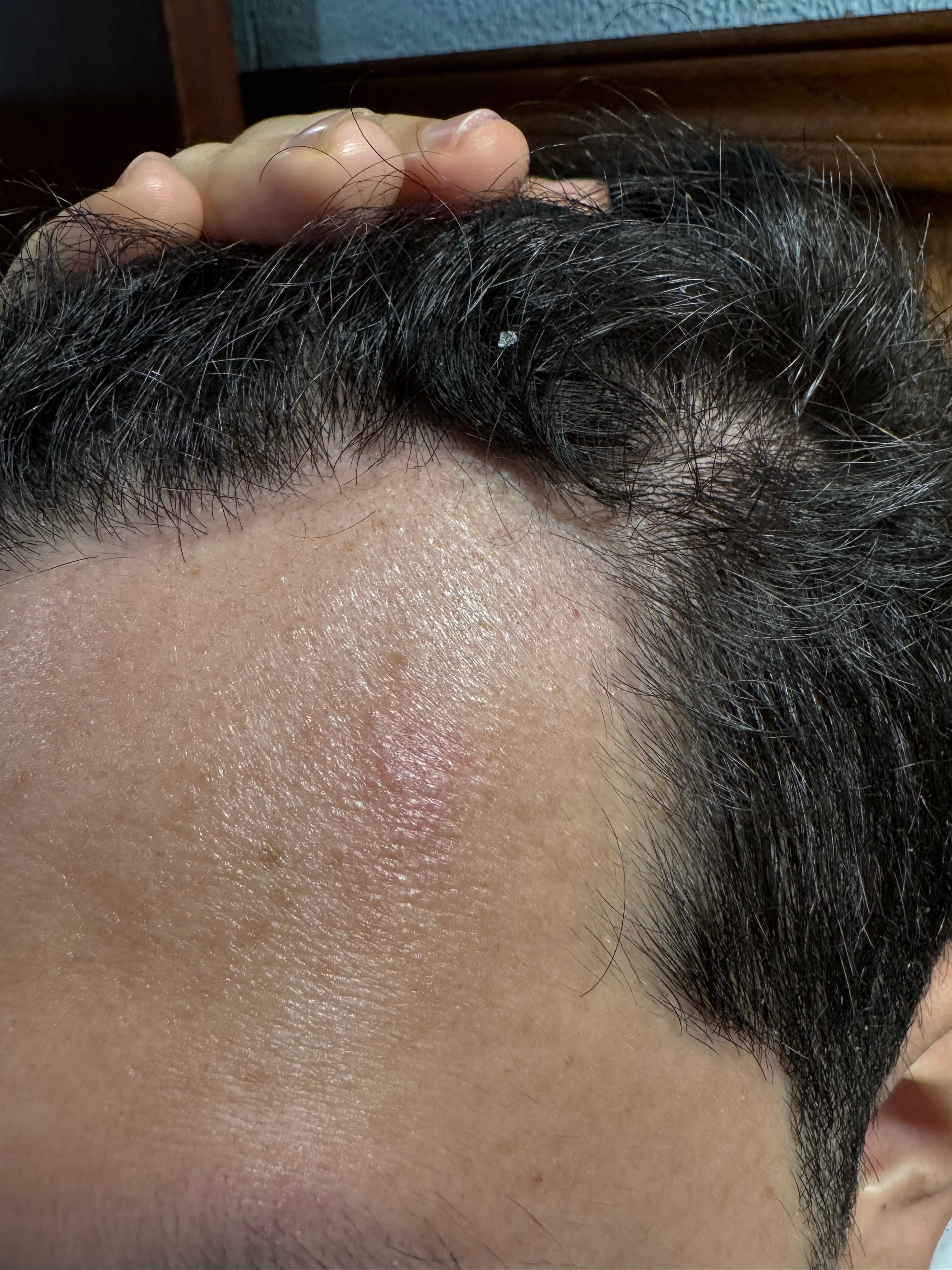 ALOPECIA ANDROGENETICA Patron masculino