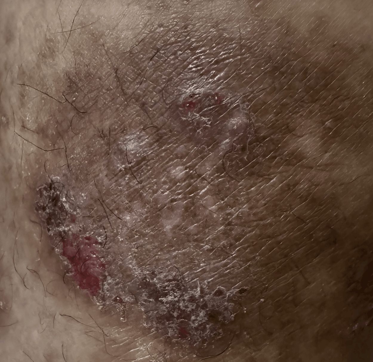 ECCEMA CRONICO