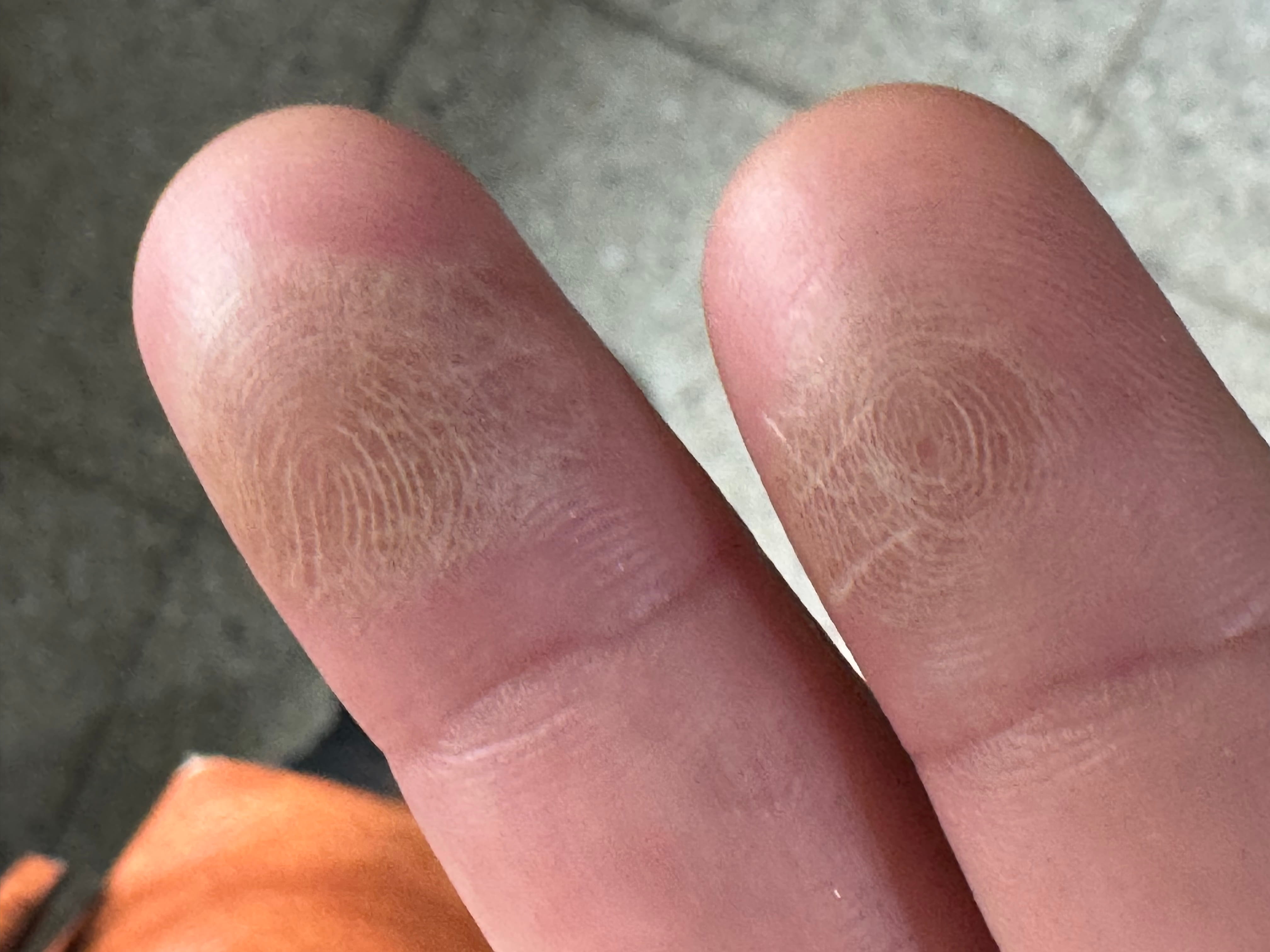 ECCEMA POR CONTACTO -  Productos de limpieza