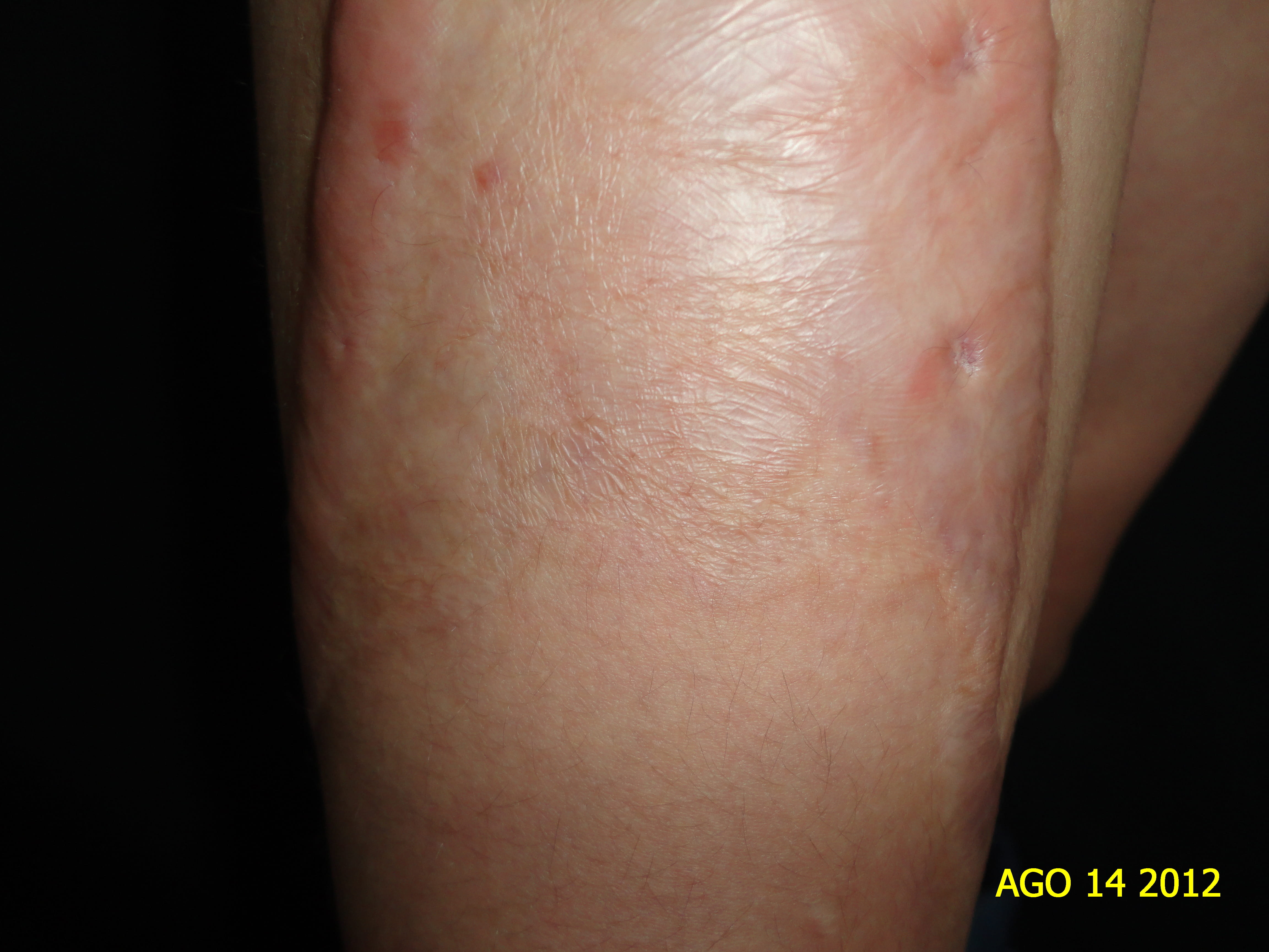 CICATRIZ ATROFICA - Post quemadura