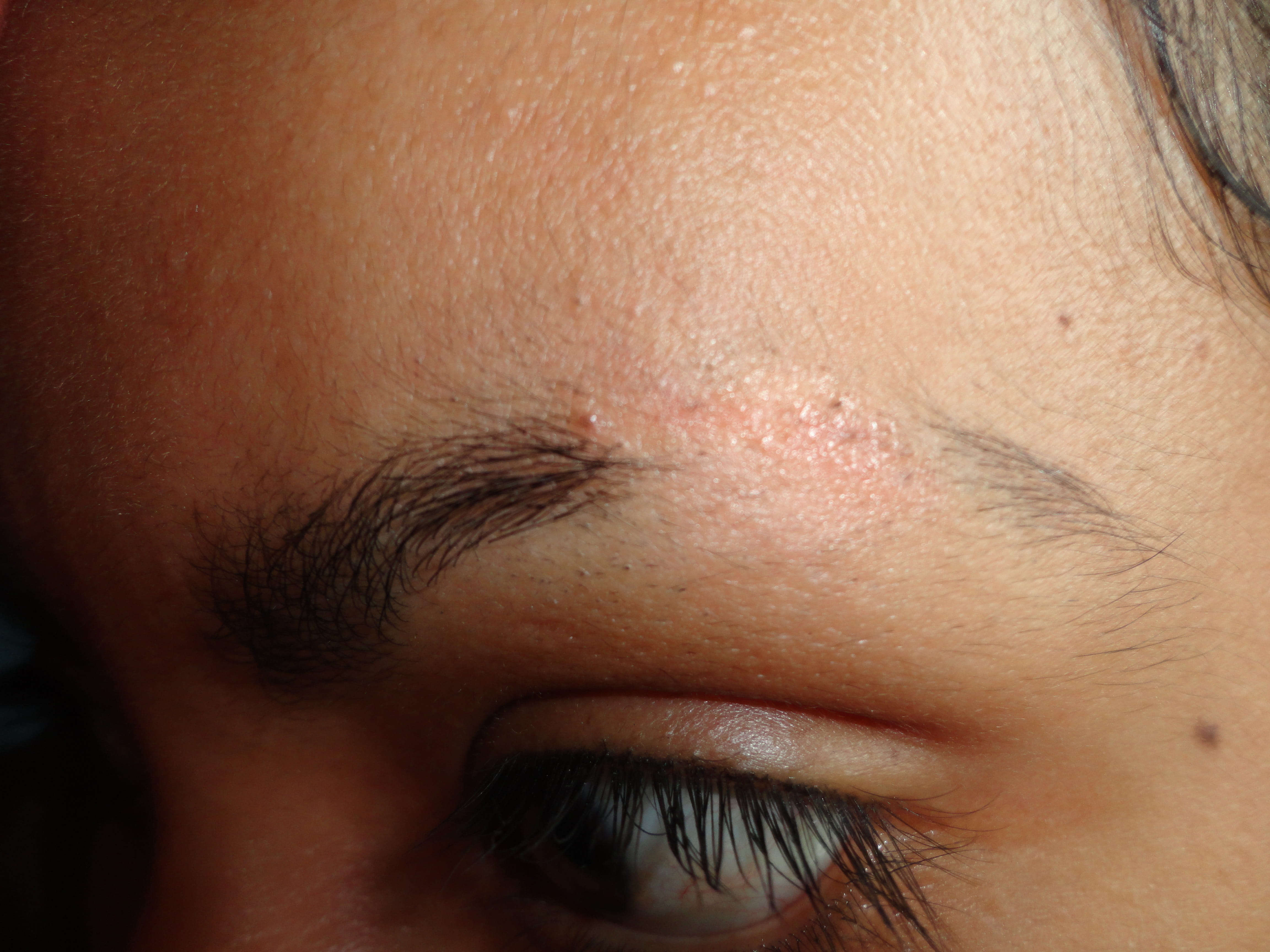 CICATRIZ ATROFICA - Post trauma