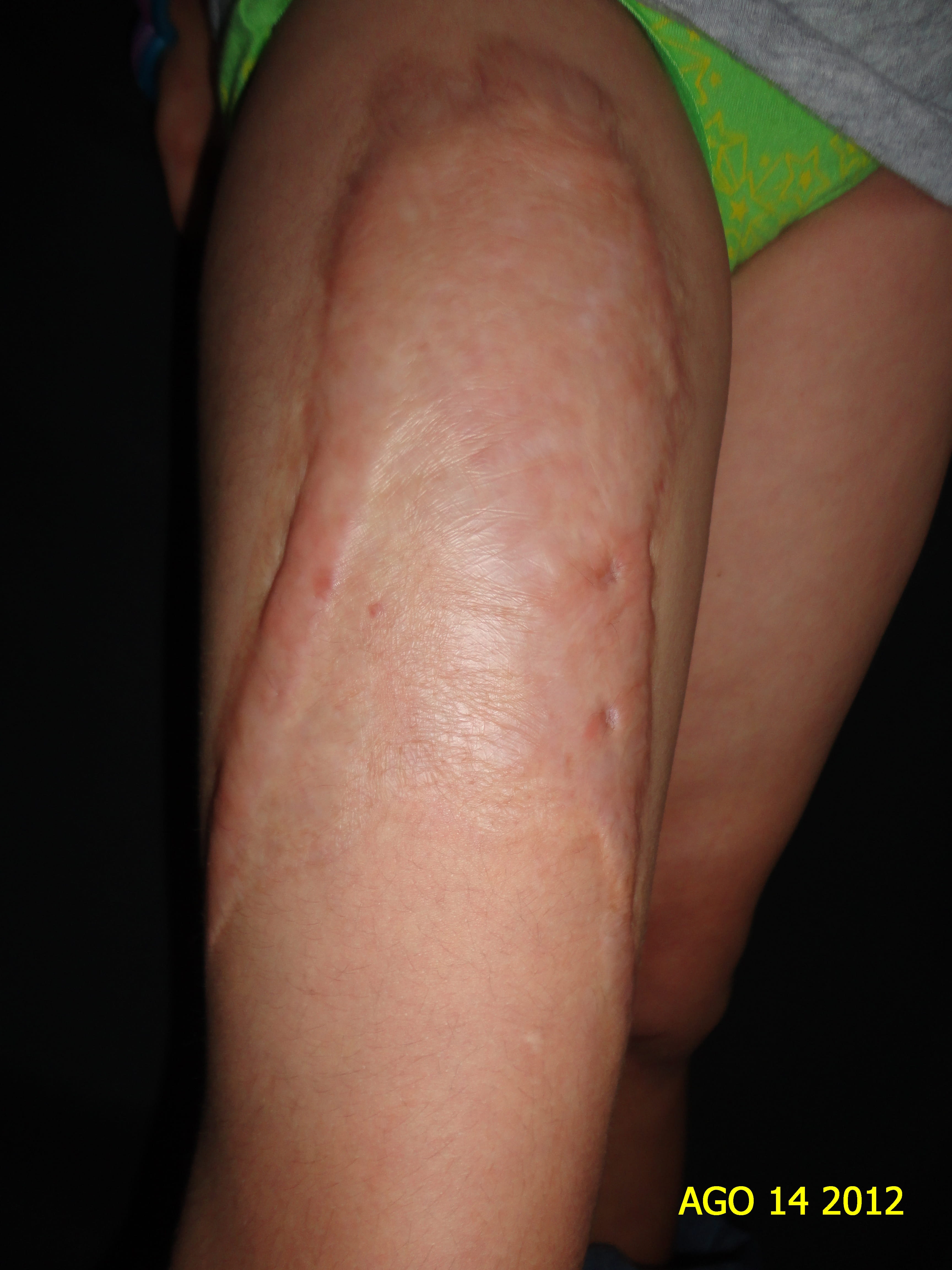 QUELOIDE - Post quemadura