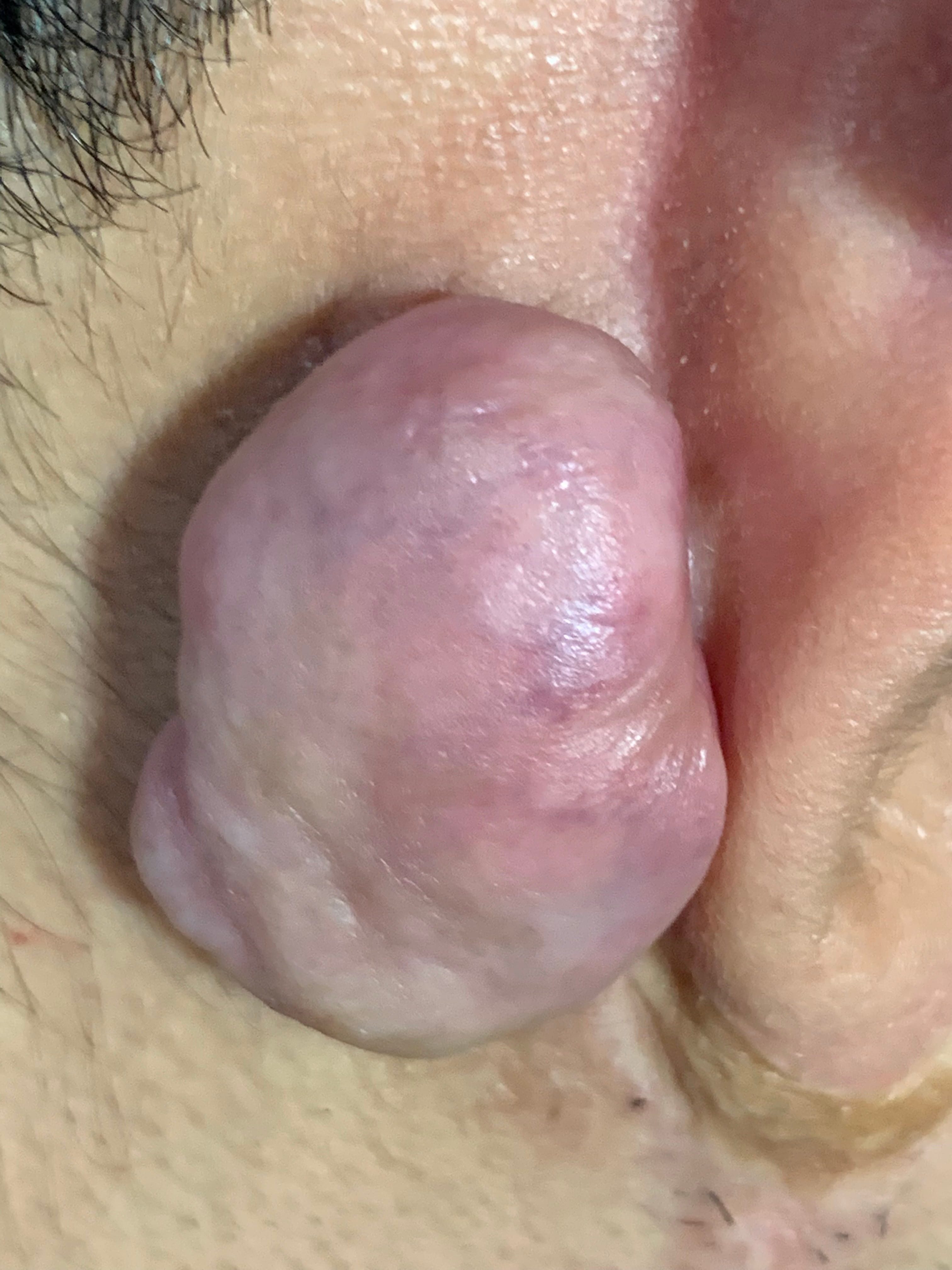 QUELOIDE - Punción por aritos