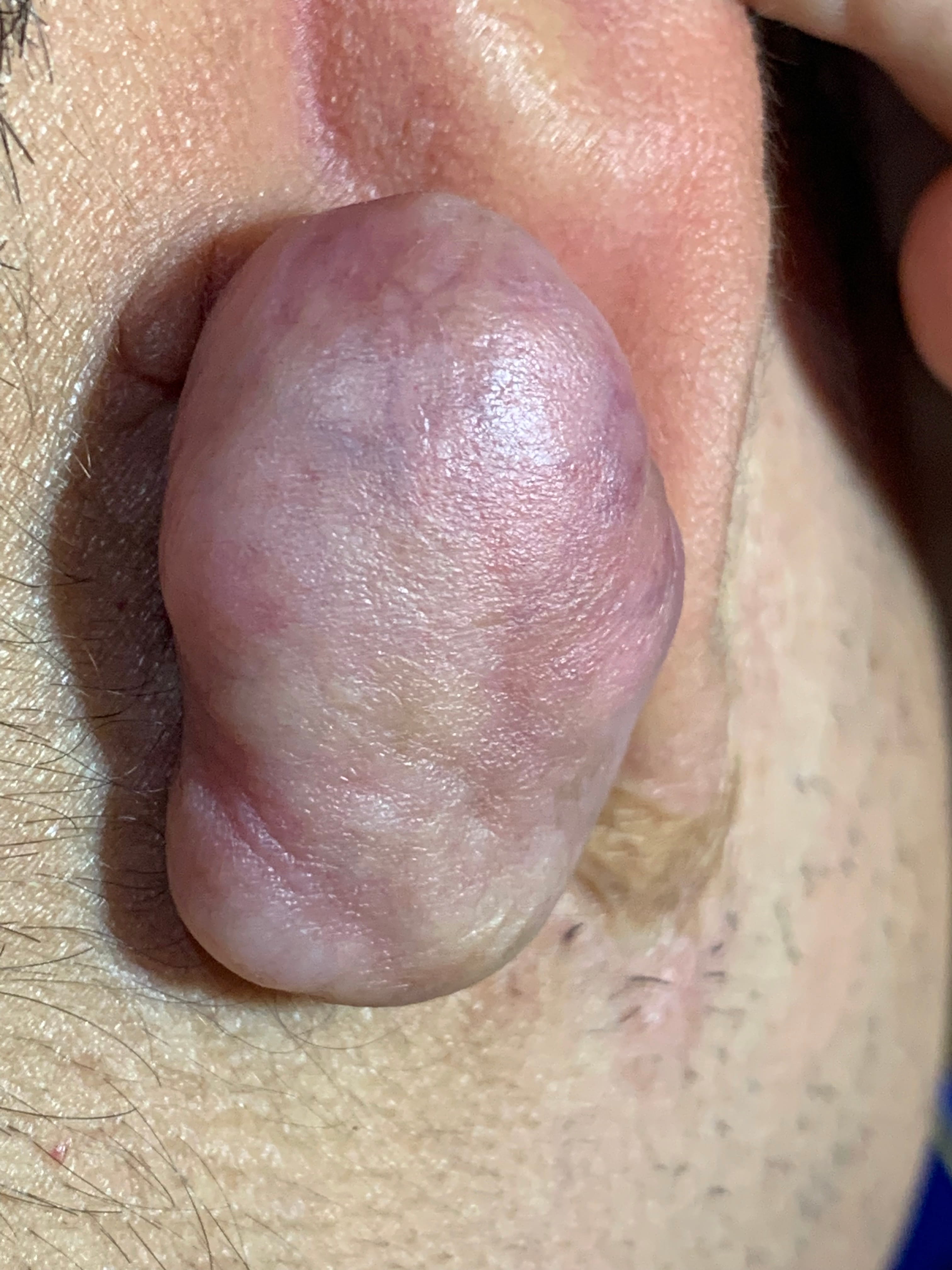 QUELOIDE - Punción por aritos