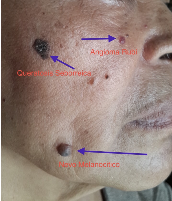 NEVO MELANOCITICO y Queratosis Seborreica