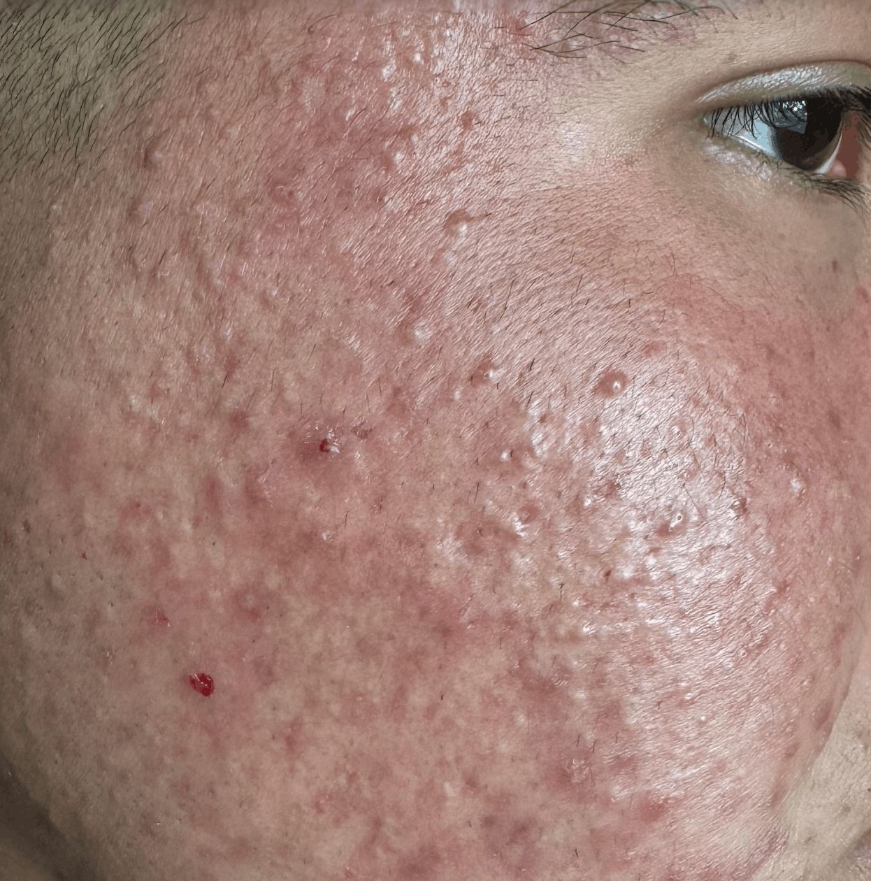 ACNE JUVENIL