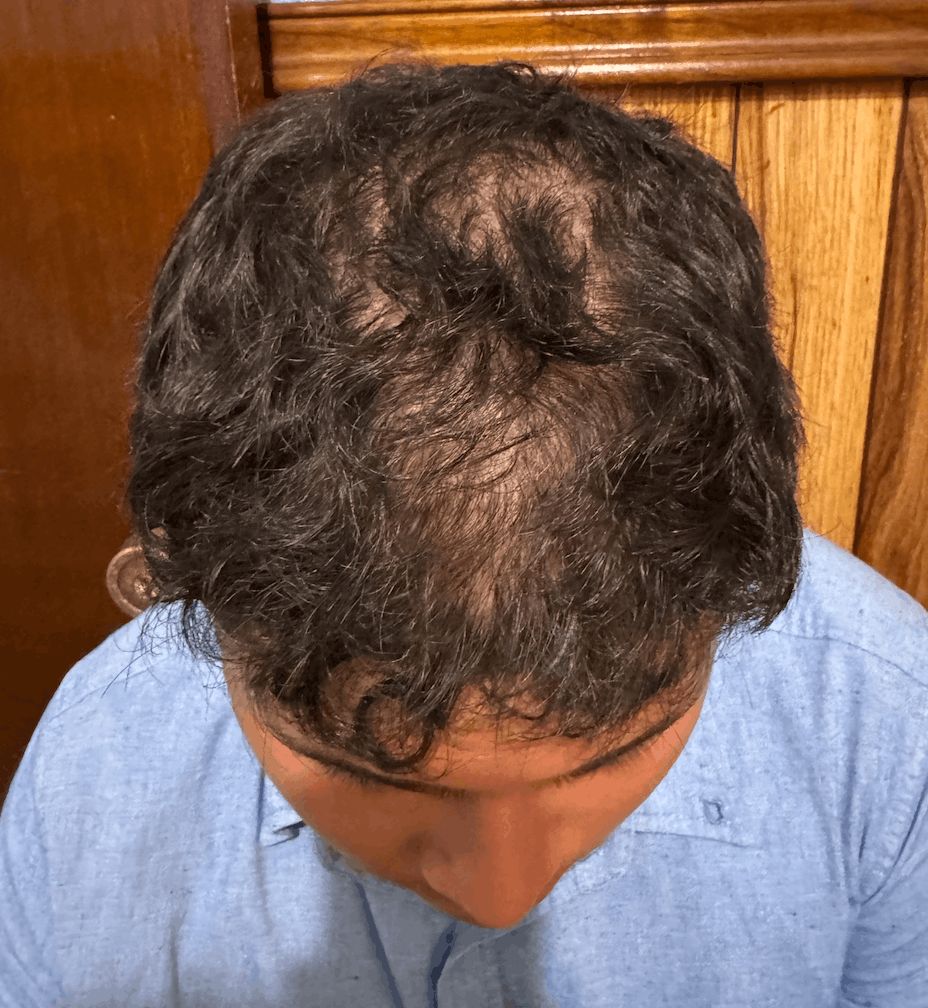 ALOPECIA ANDROGENETICA MASCULINA