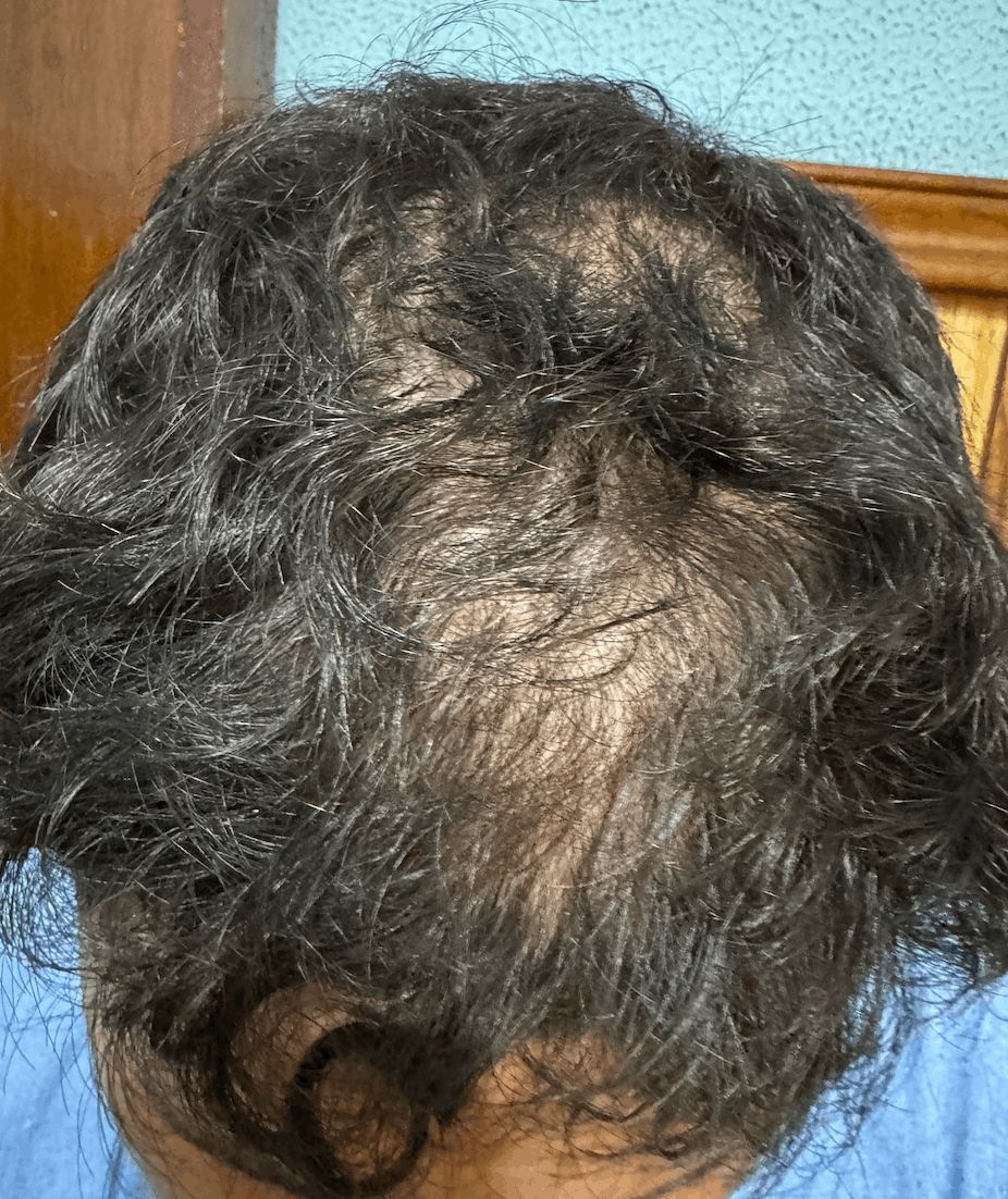 ALOPECIA ANDROGENETICA MASCULINA