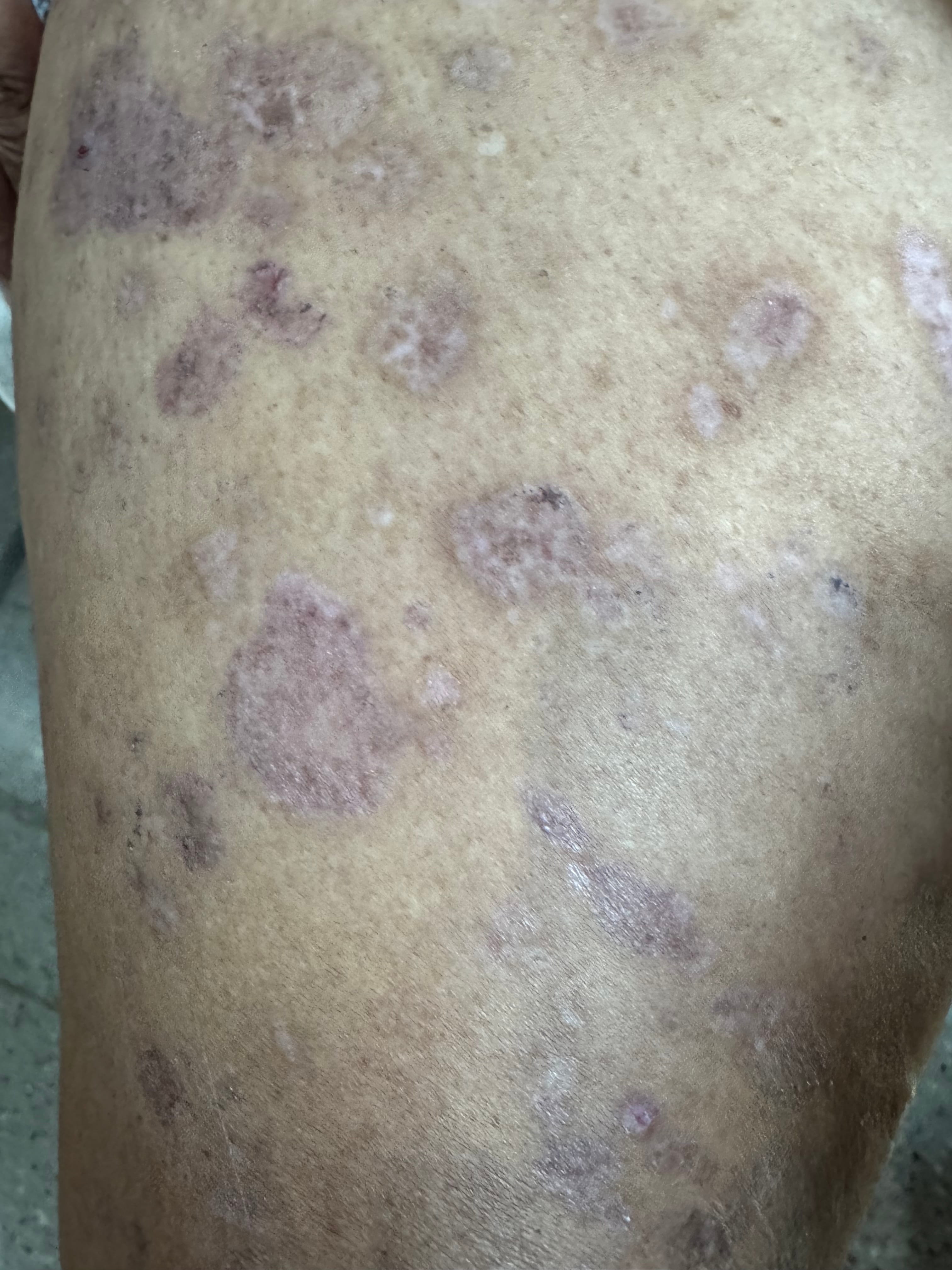 HIPERCROMIA POST INFLAMATORIA