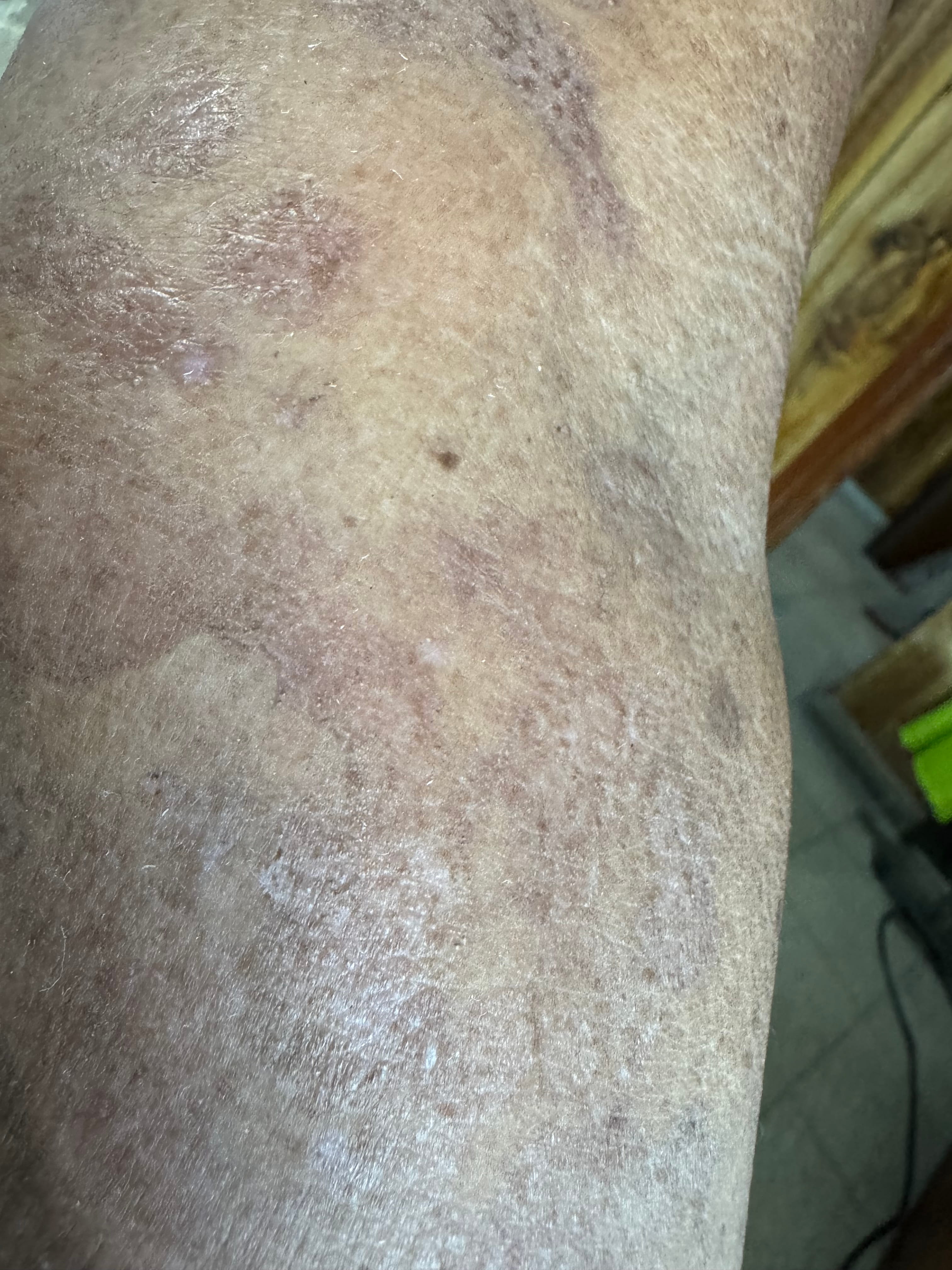 HIPERCROMIA POST INFLAMATORIA