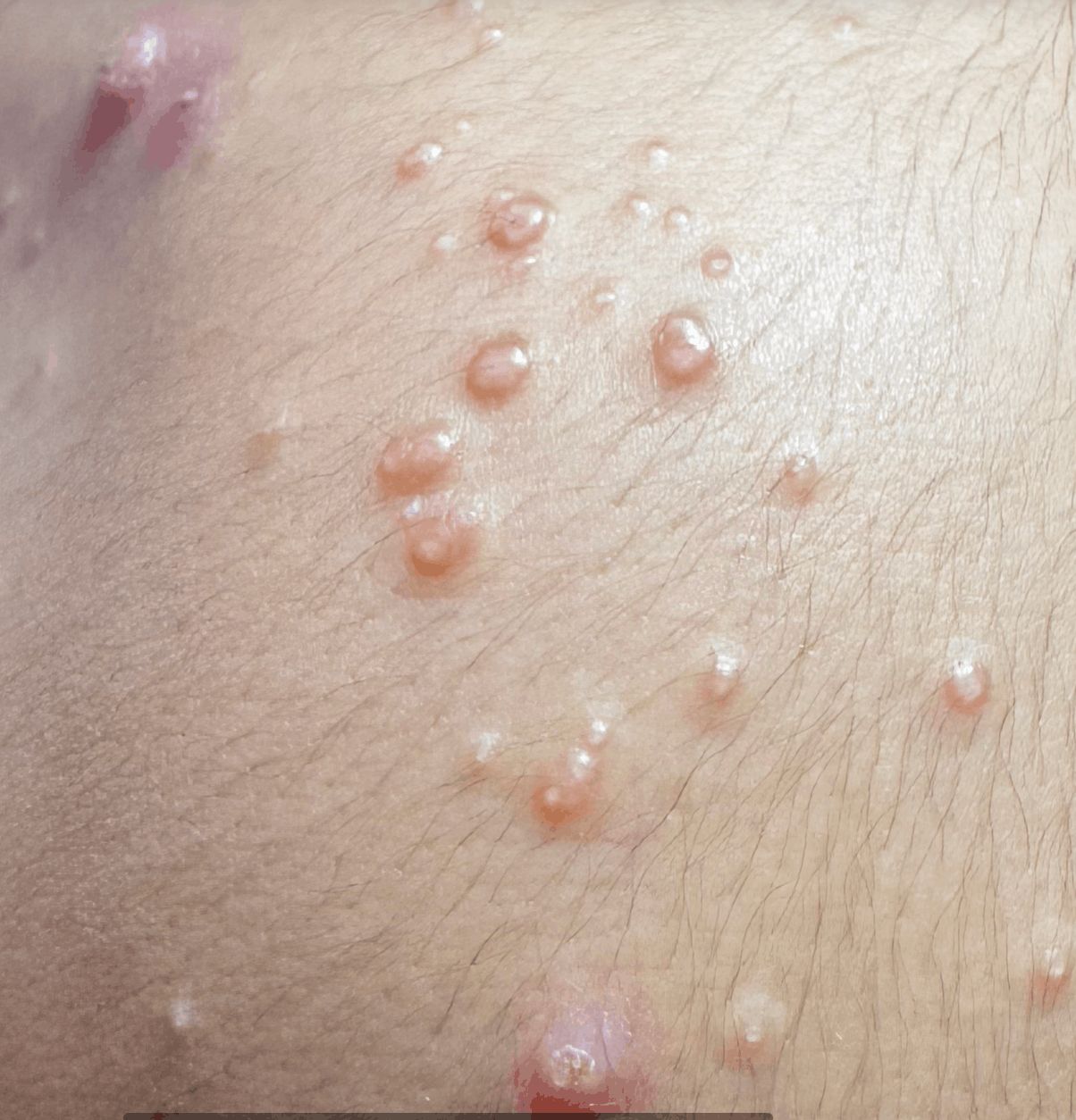 MOLUSCO CONTAGIOSO