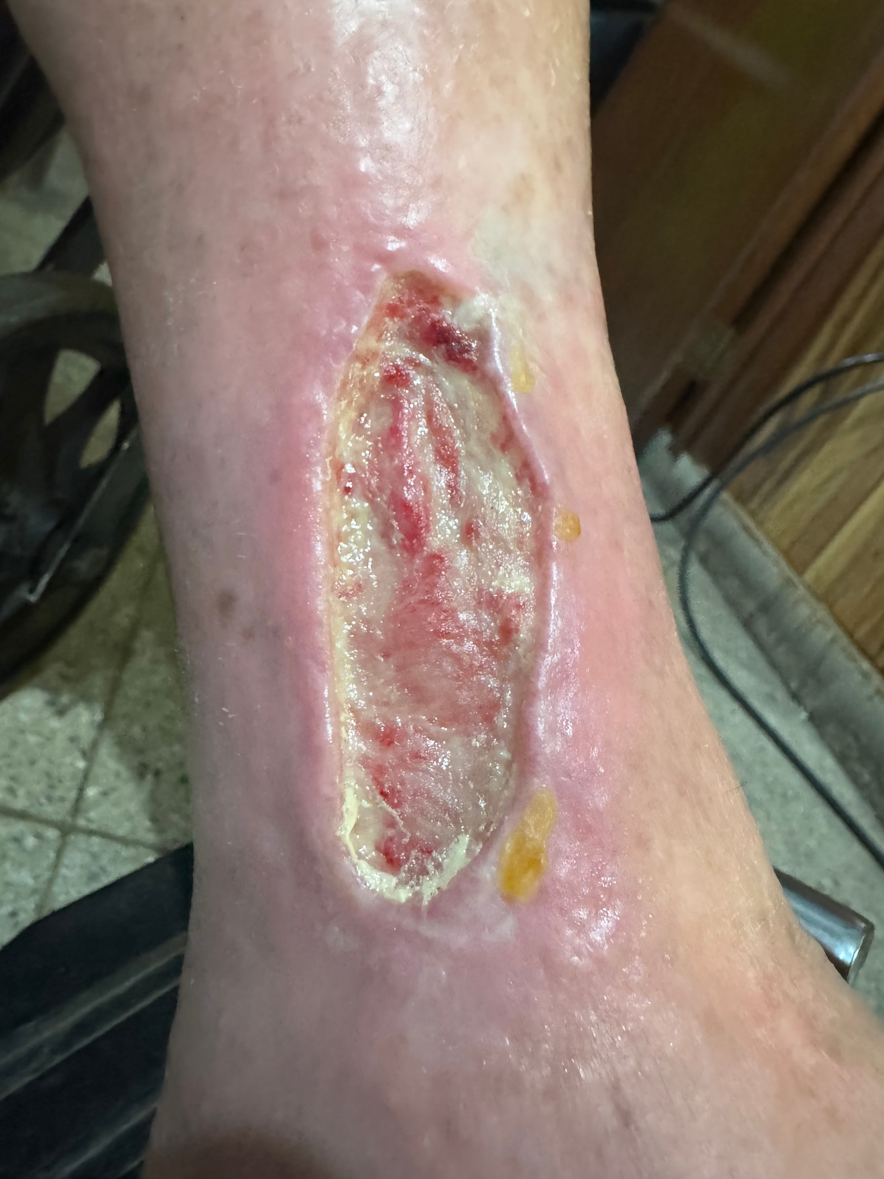 ULCERA ARTERIAL