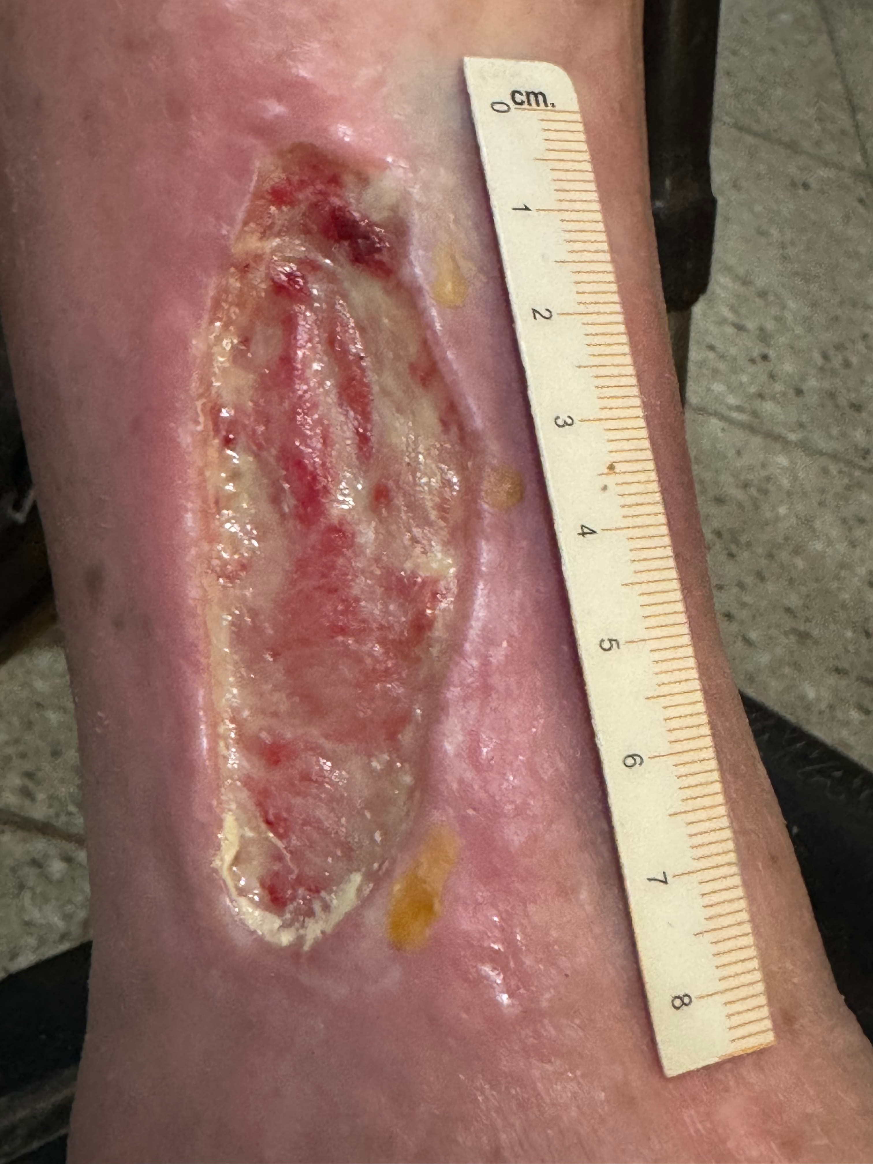 ULCERA ARTERIAL