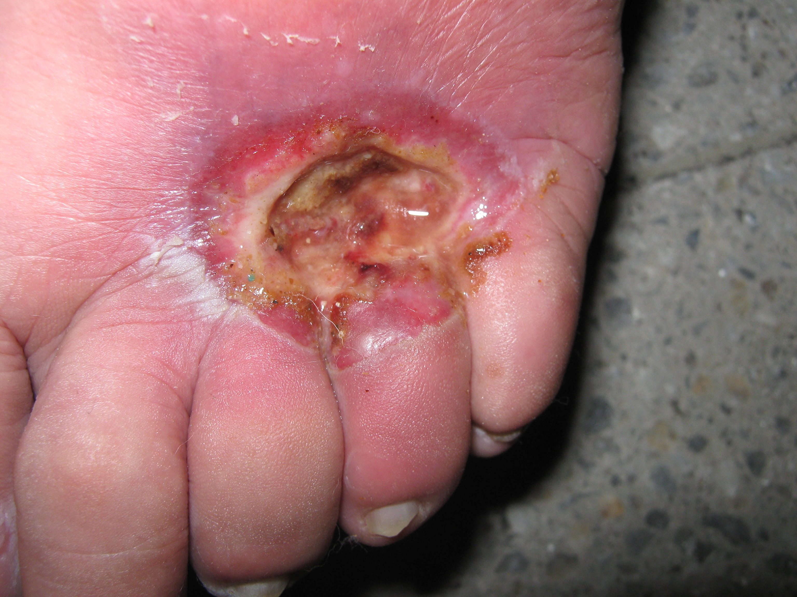 ULCERA - Pie diabético