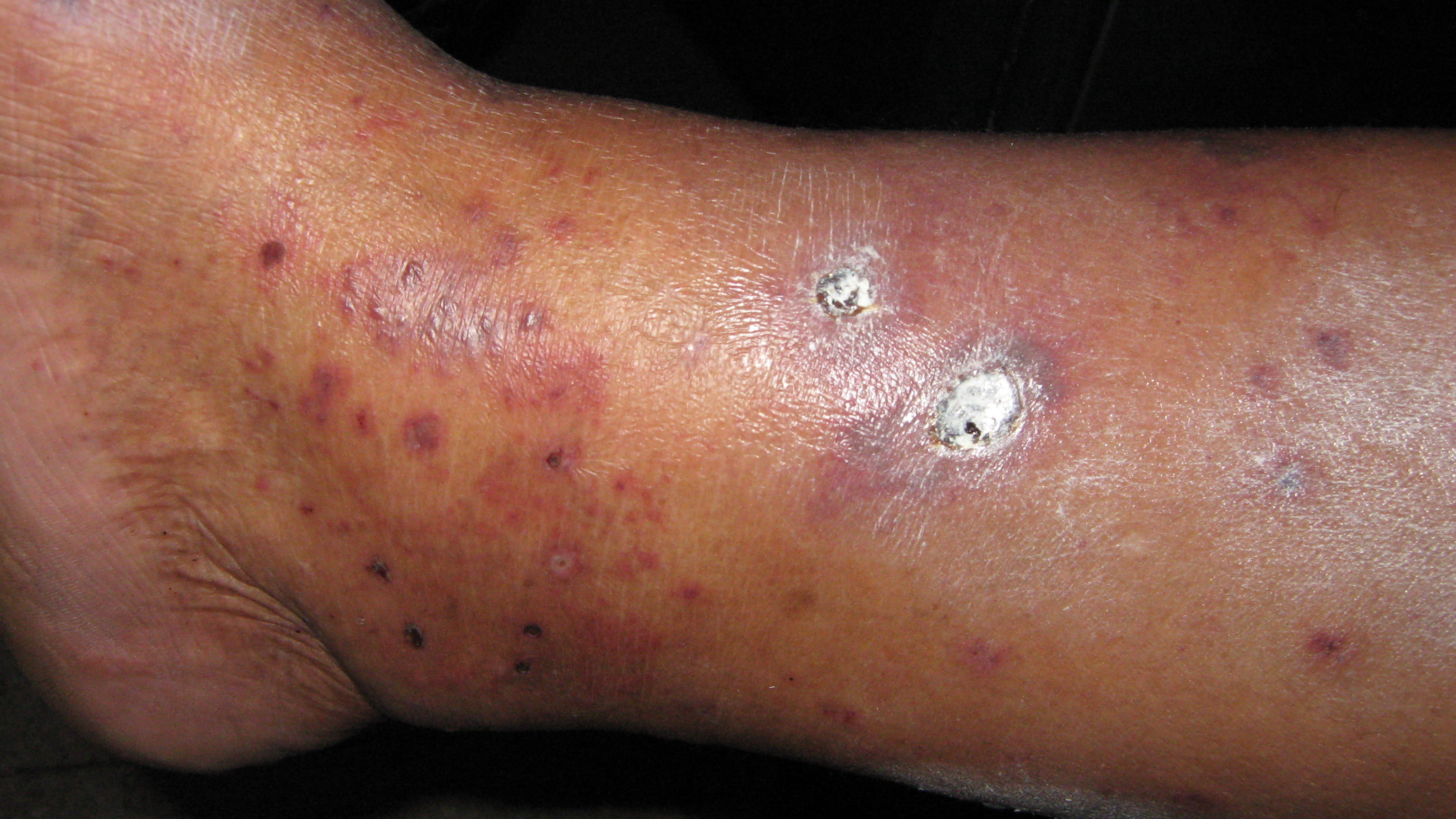 ULCERA - Vasculitis Leucocitoclastica