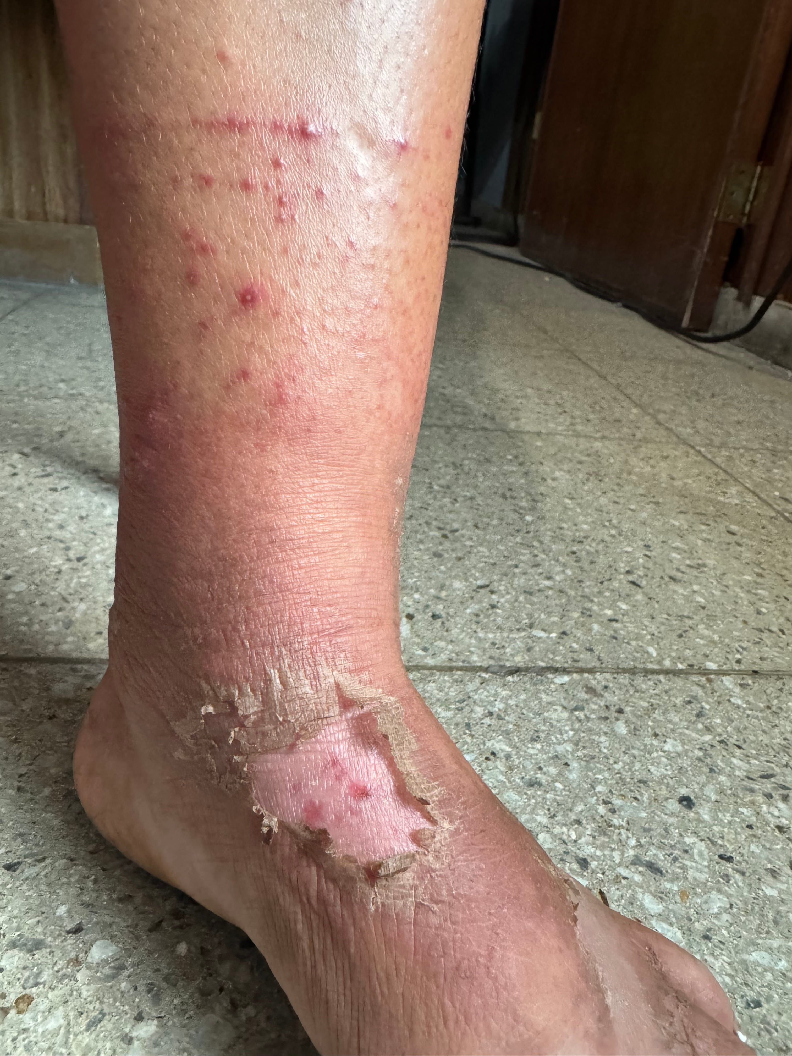 DERMATITIS POR CONTACTO - Botas de hule
