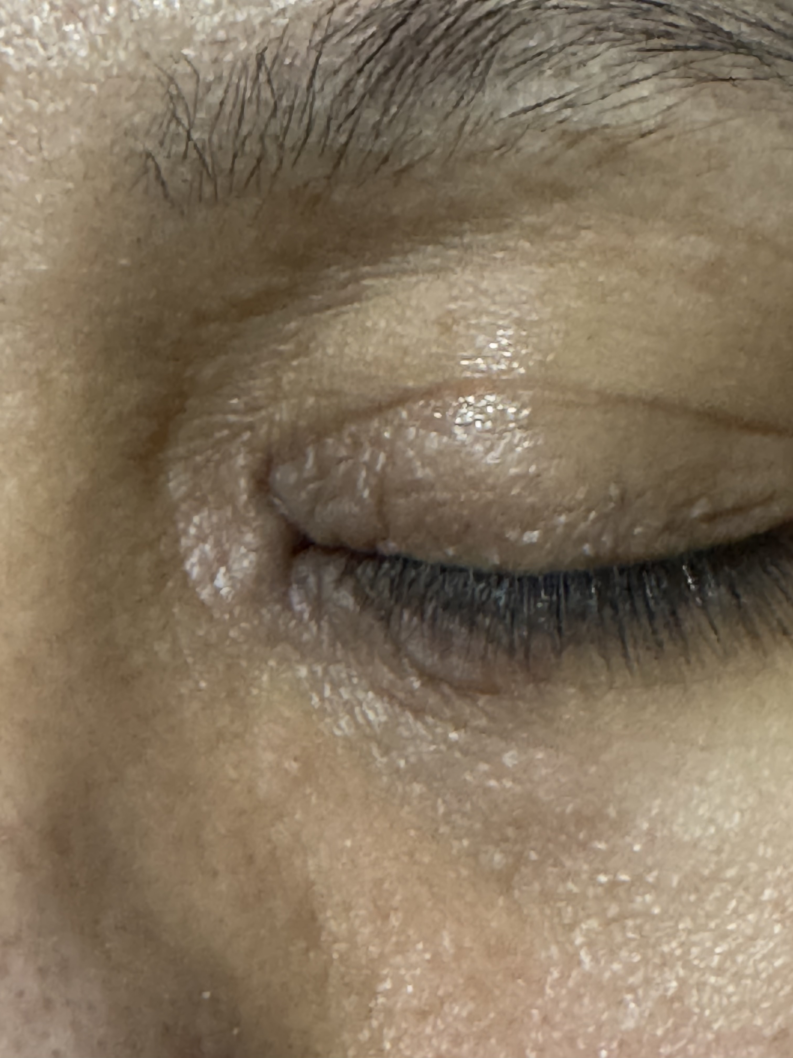 DERMATITIS POR CONTACTO - Esmalte de uñas