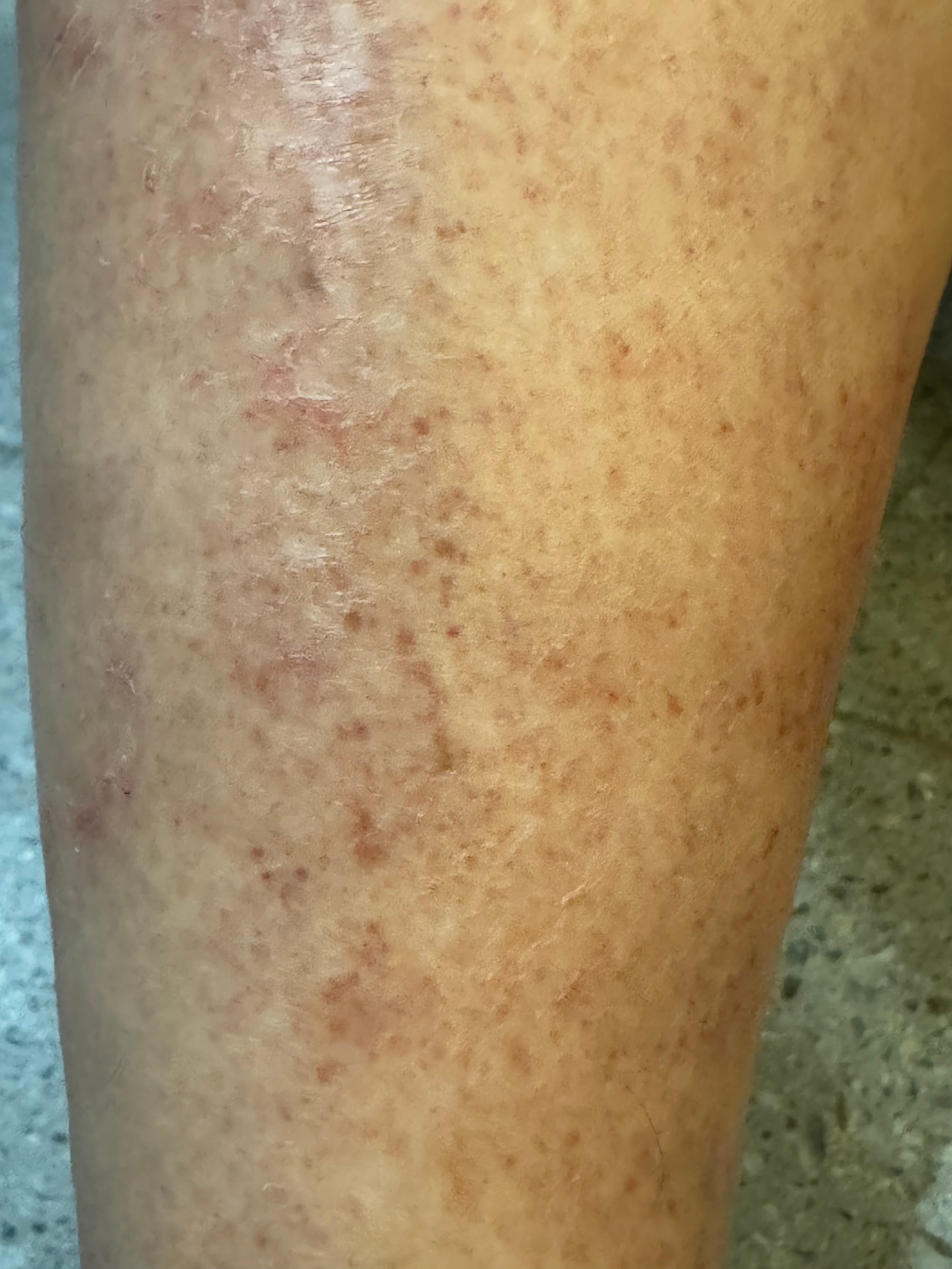 VASCULITIS Leucocitoplástica