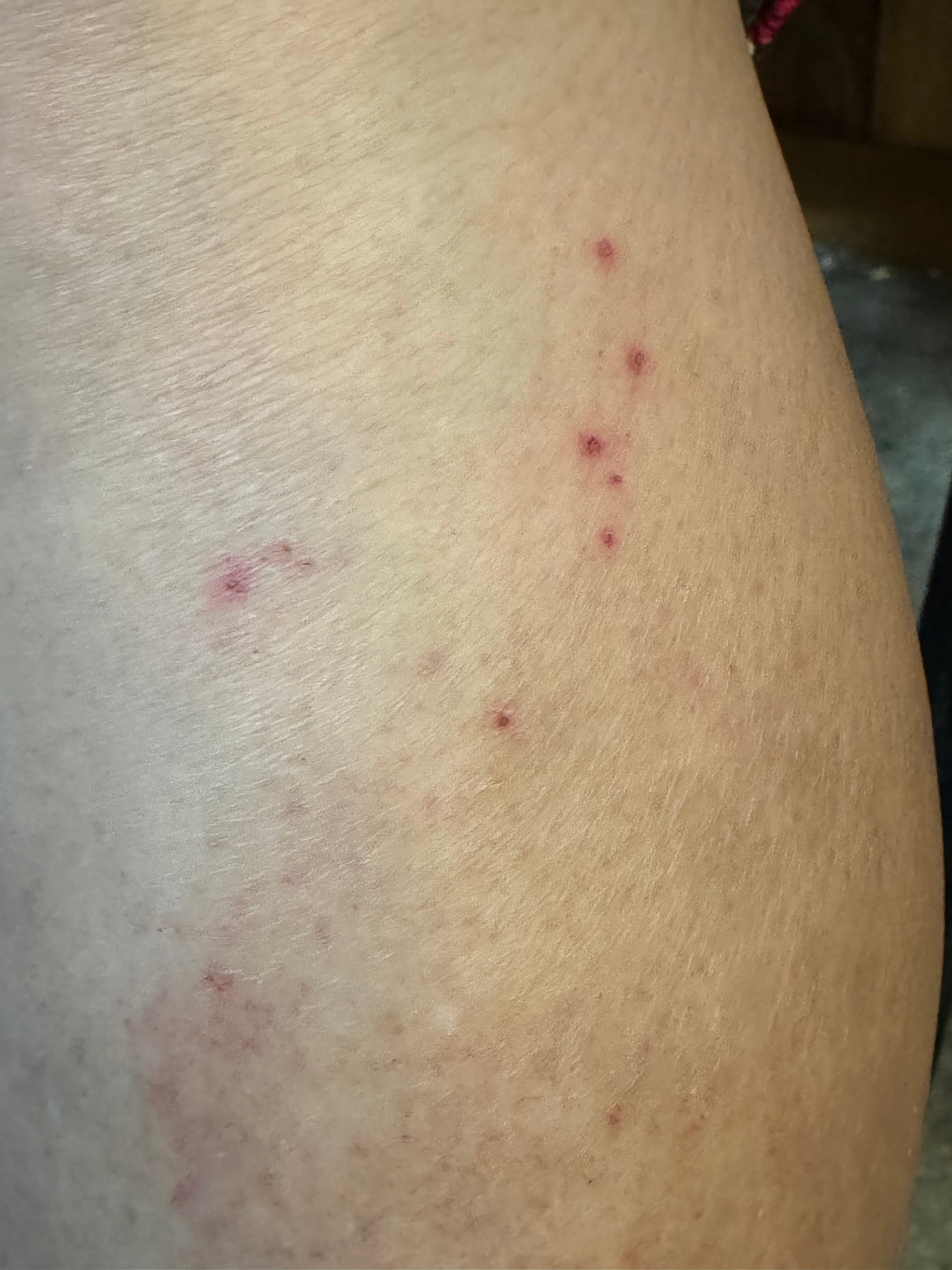 VASCULITIS Leucocitoplástica