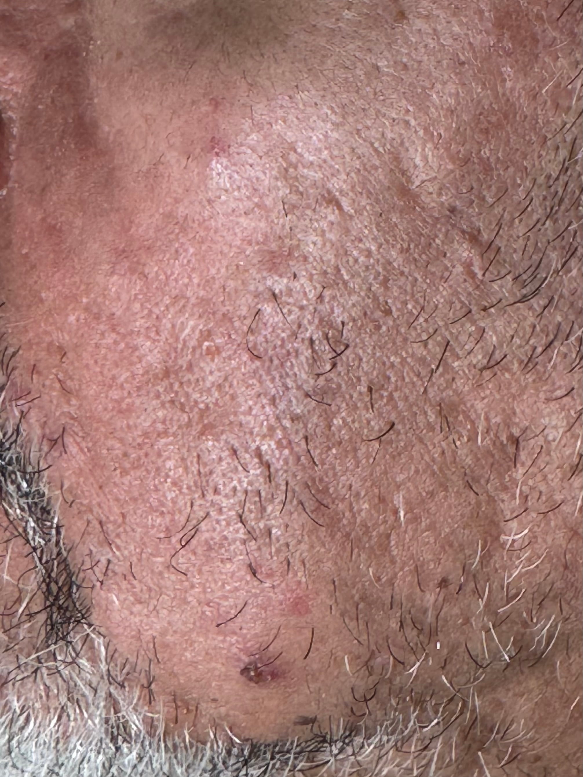 ACNE VULGAR - Adulto 52 años