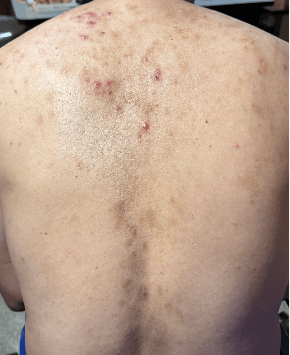 ACNE VULGAR - Adulto 52 años