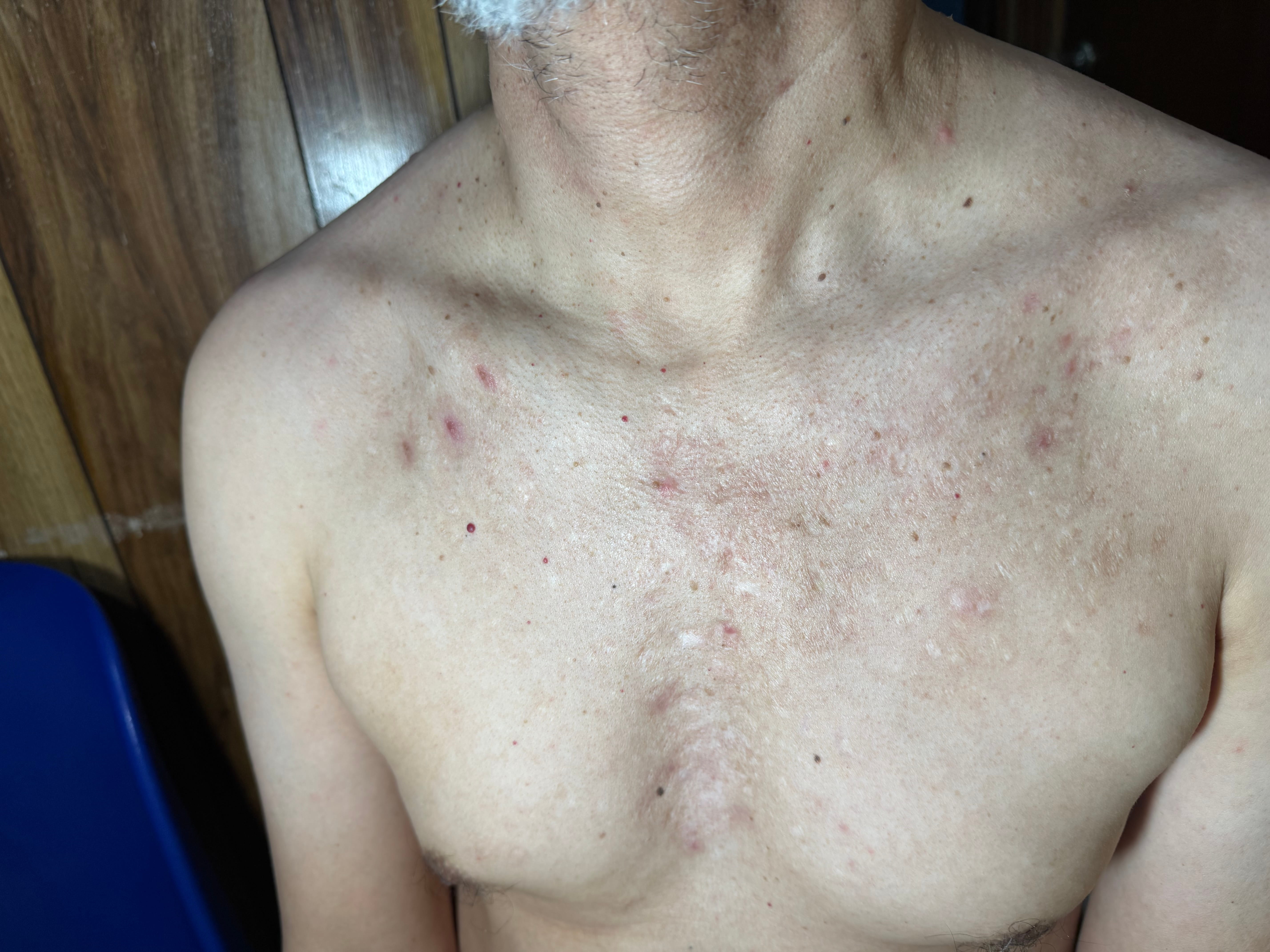 ACNE VULGAR - Adulto 52 años