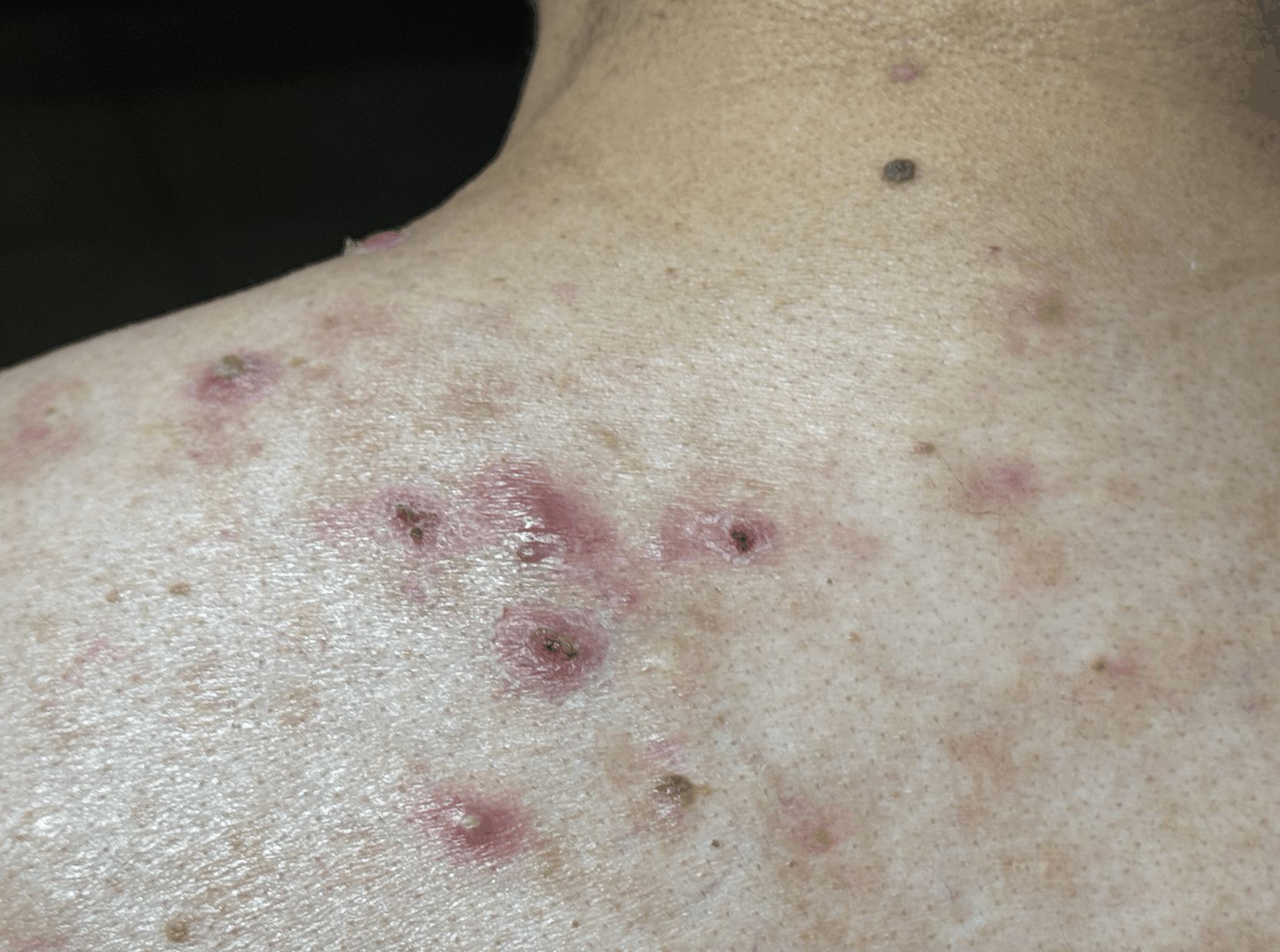 ACNE VULGAR - Adulto 52 años