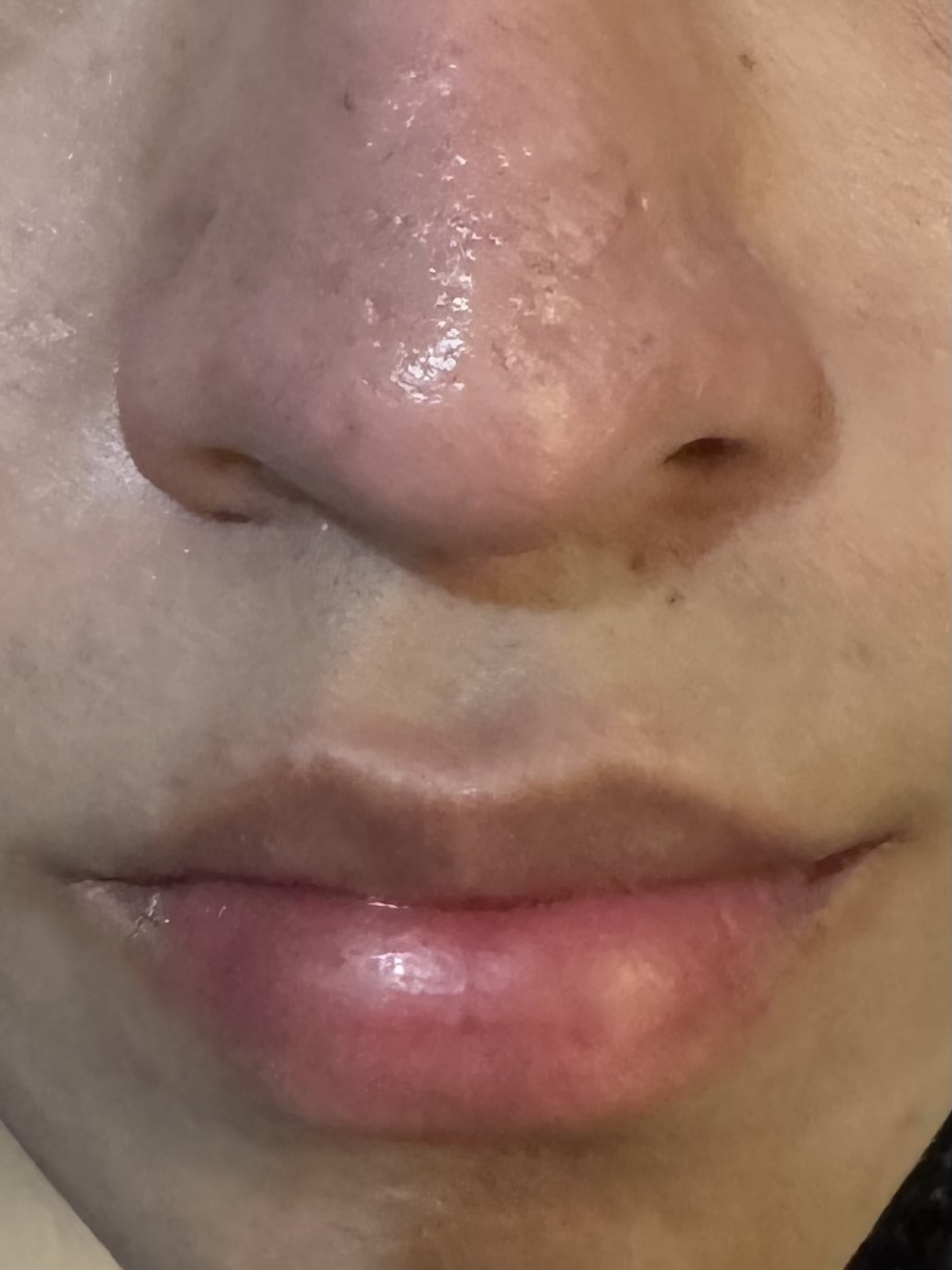 ROSACEA