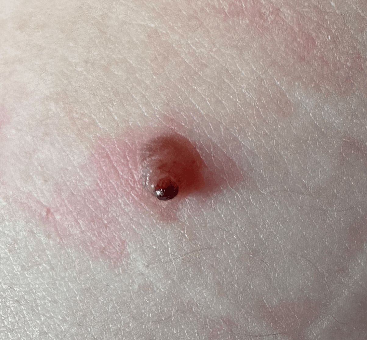 NEVO MELANOCITICO traumatizado
