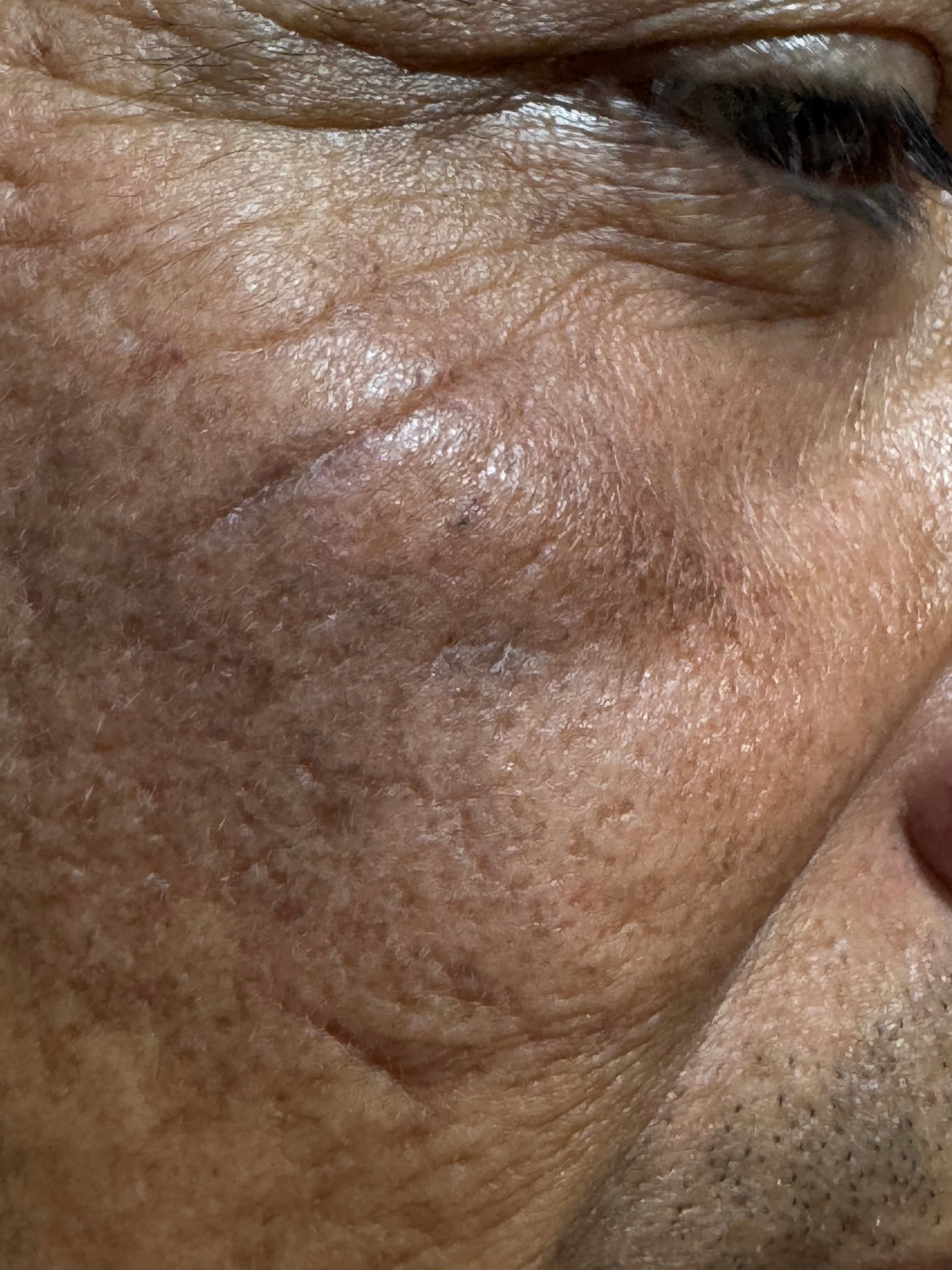 OCRONOSIS - HIDROQUINONA