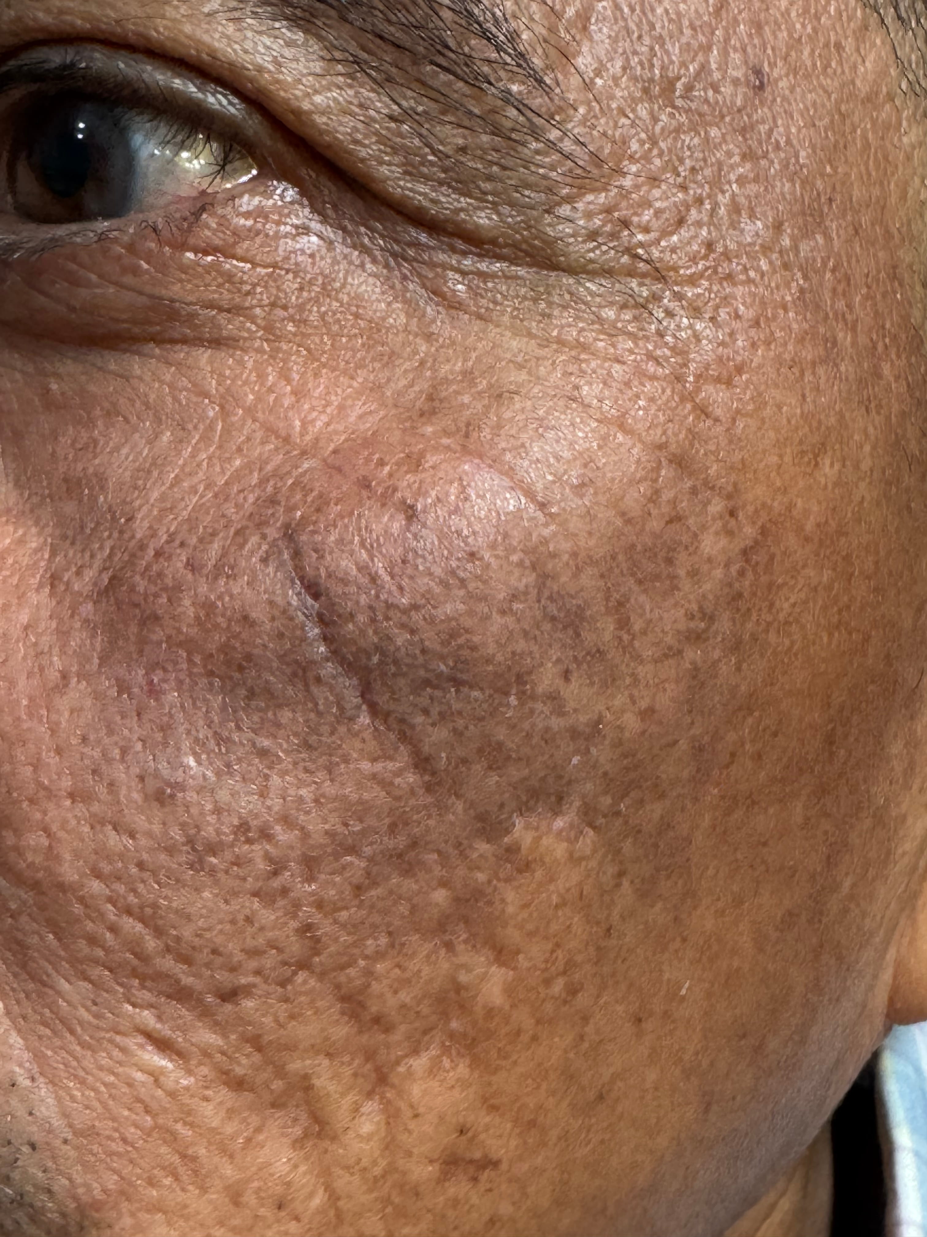 OCRONOSIS - HIDROQUINONA