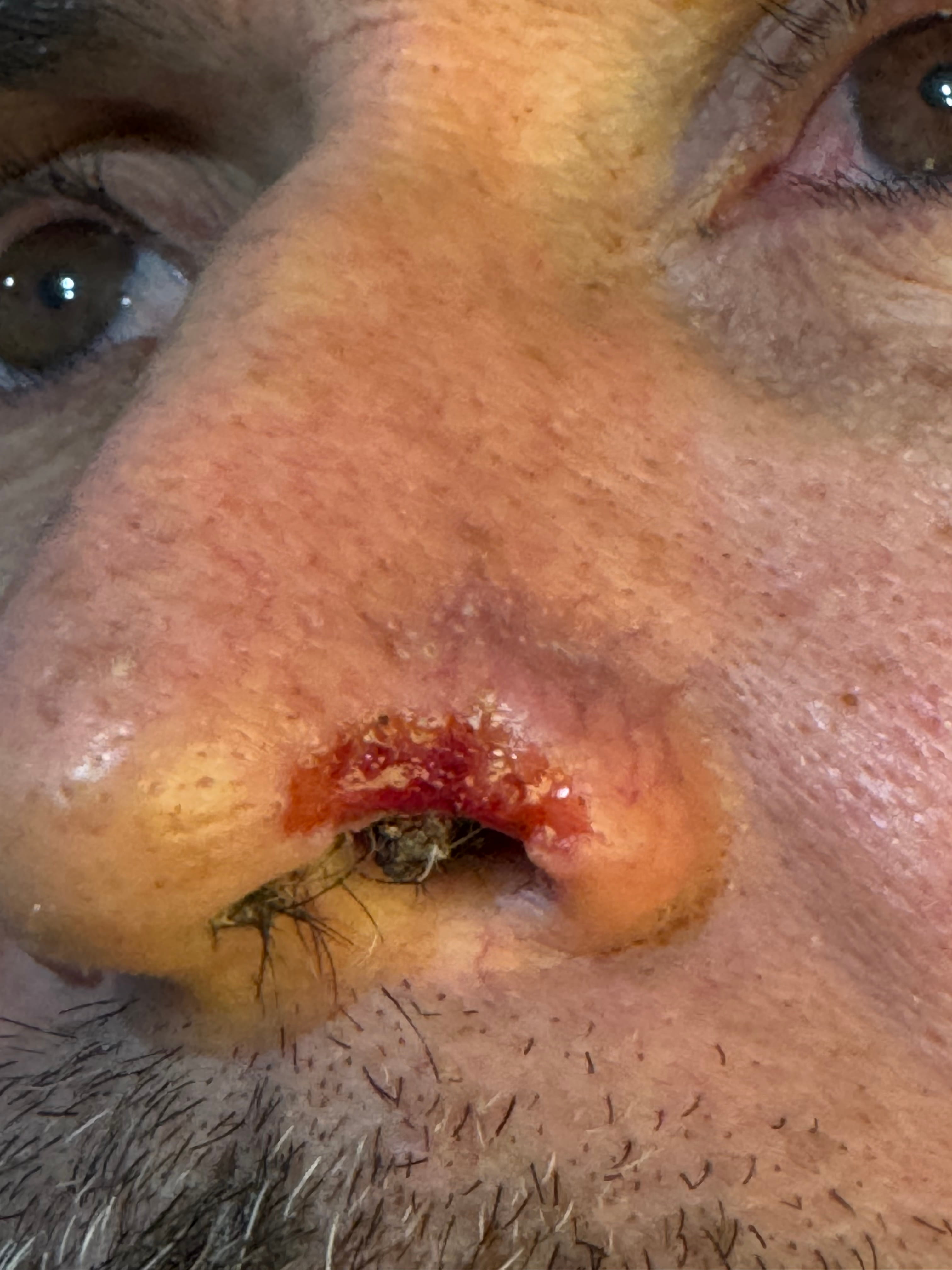 CARCINOMA BASOCELULAR ALA NASAL