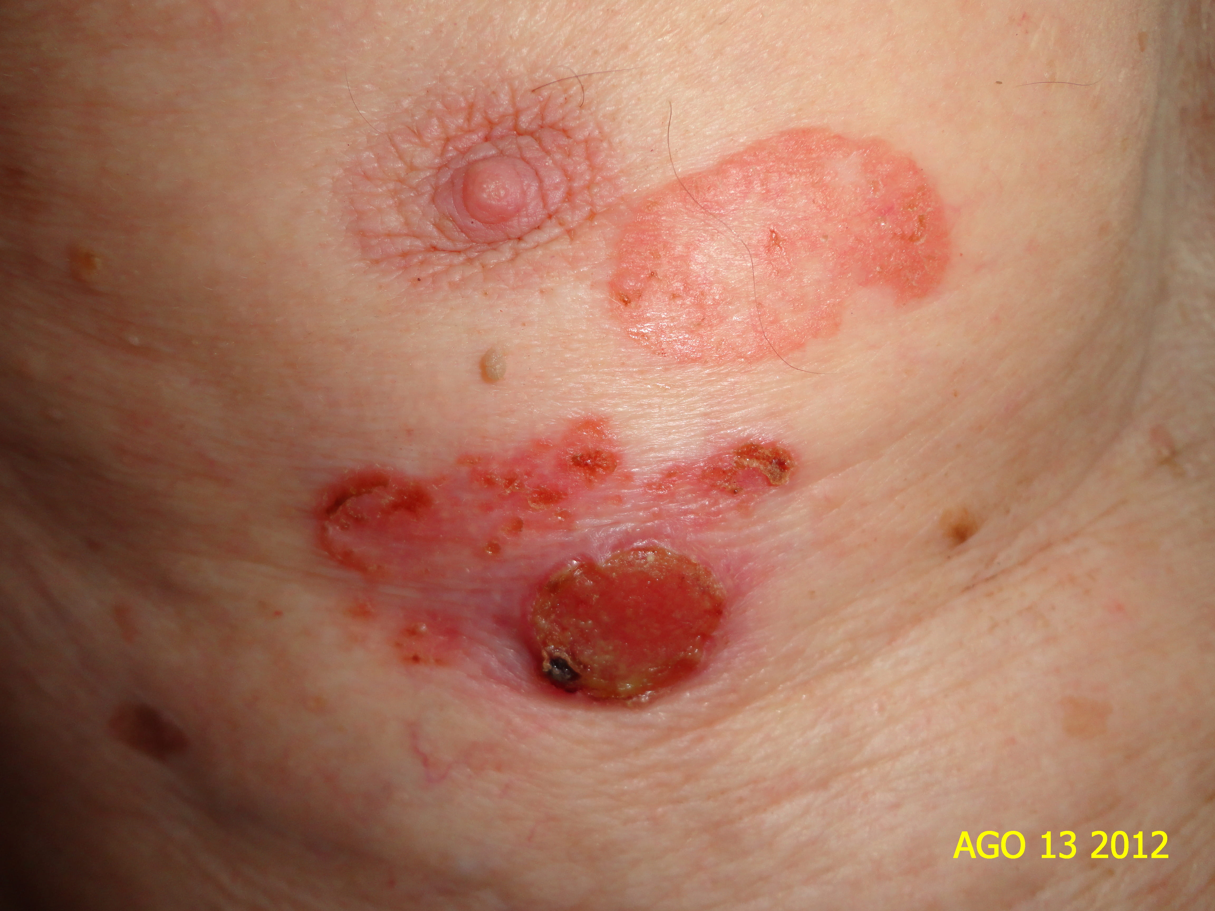 ENFERMEDAD DE BOWEN y Carcinoma Espinocelular