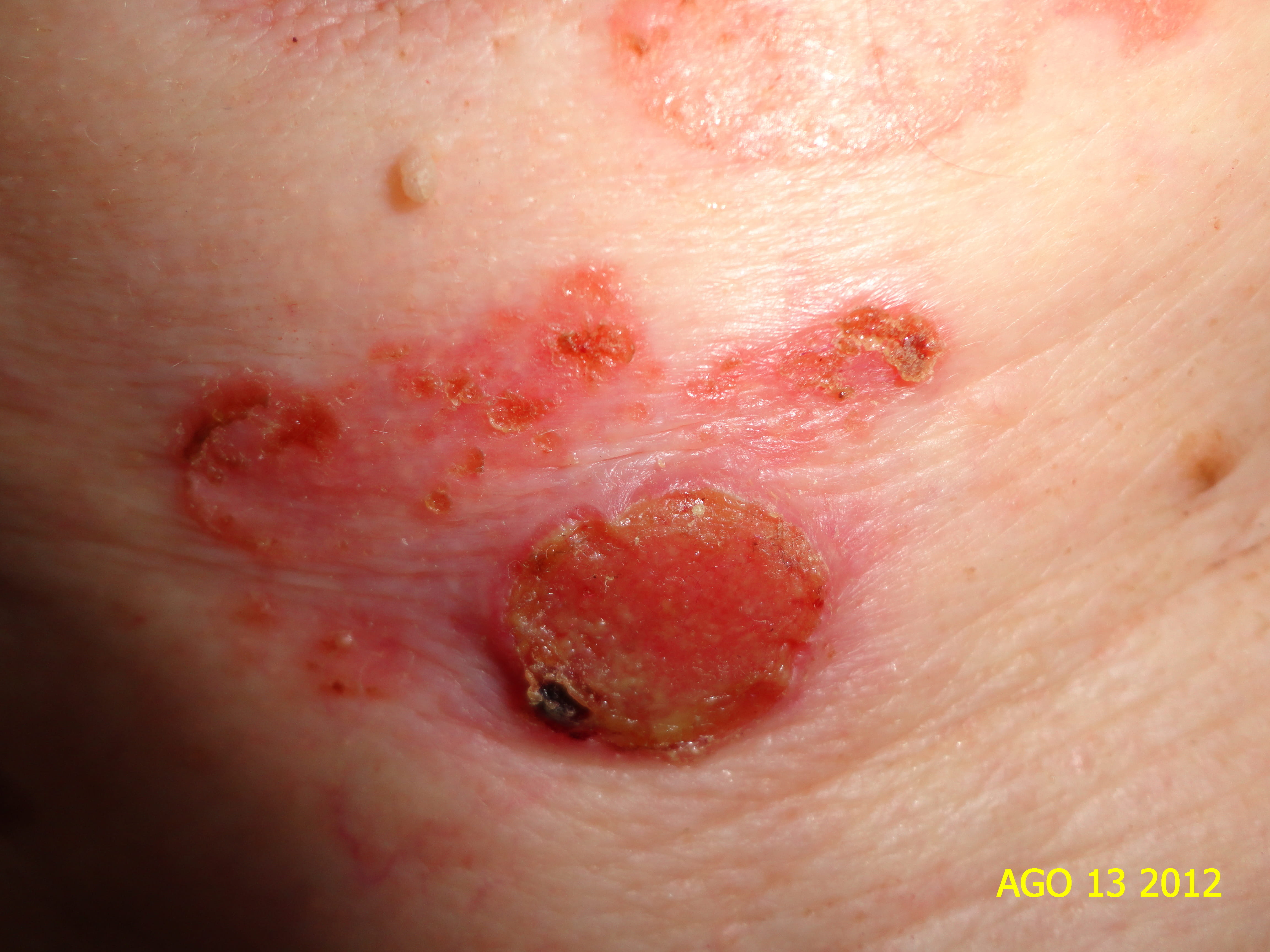 ENFERMEDAD DE BOWEN y Carcinoma Espinocelular