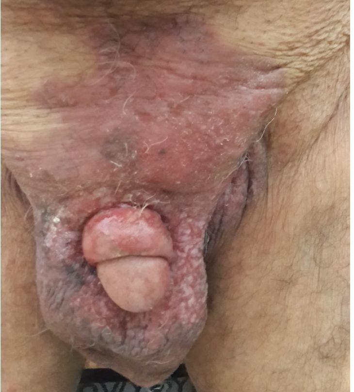 ENFERMEDAD DE PAGET y Cáncer de próstata