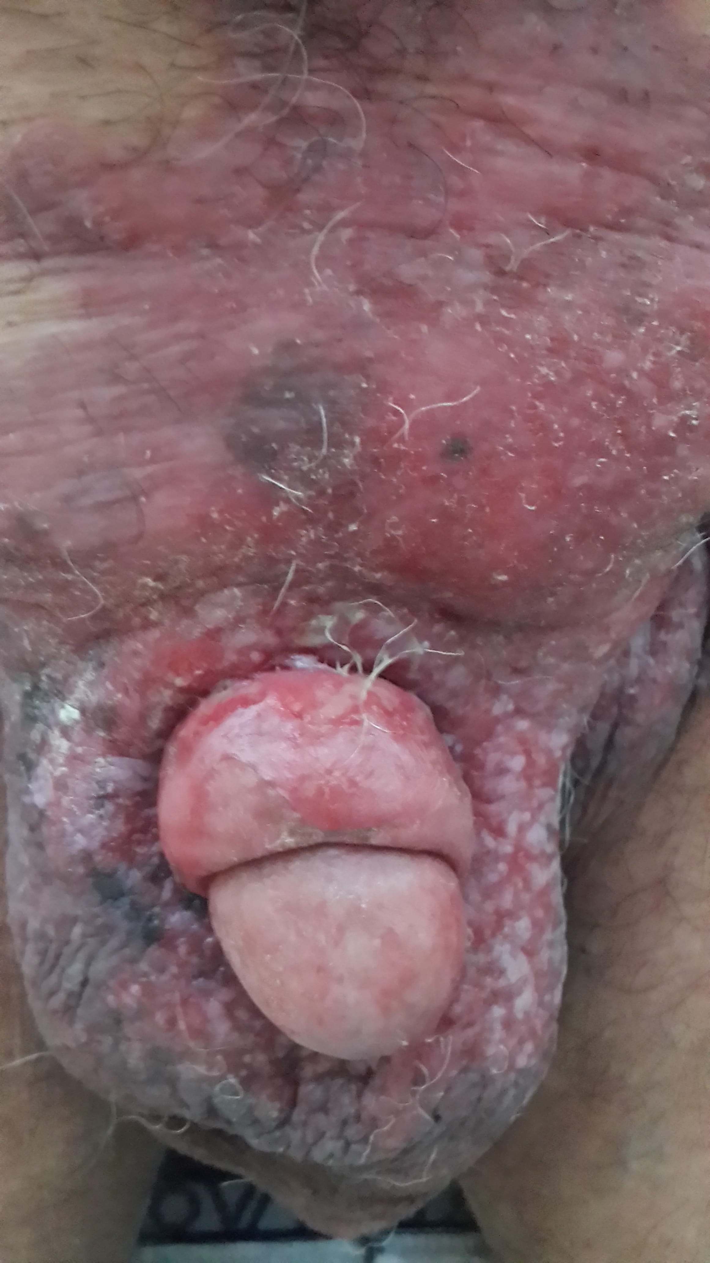 ENFERMEDAD DE PAGET y Cáncer de próstata