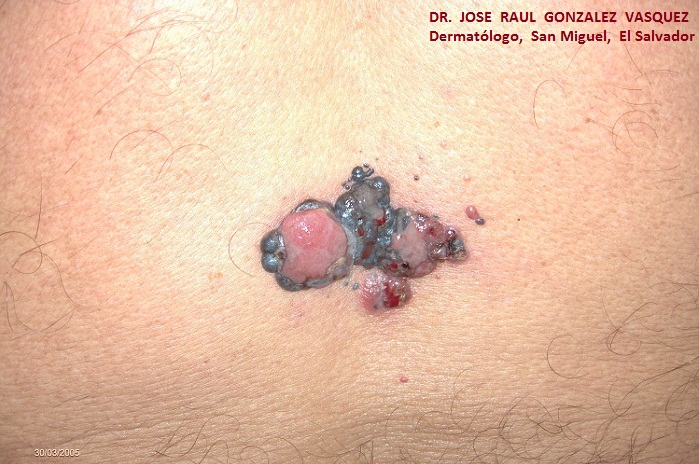 MELANOMA MALIGNO