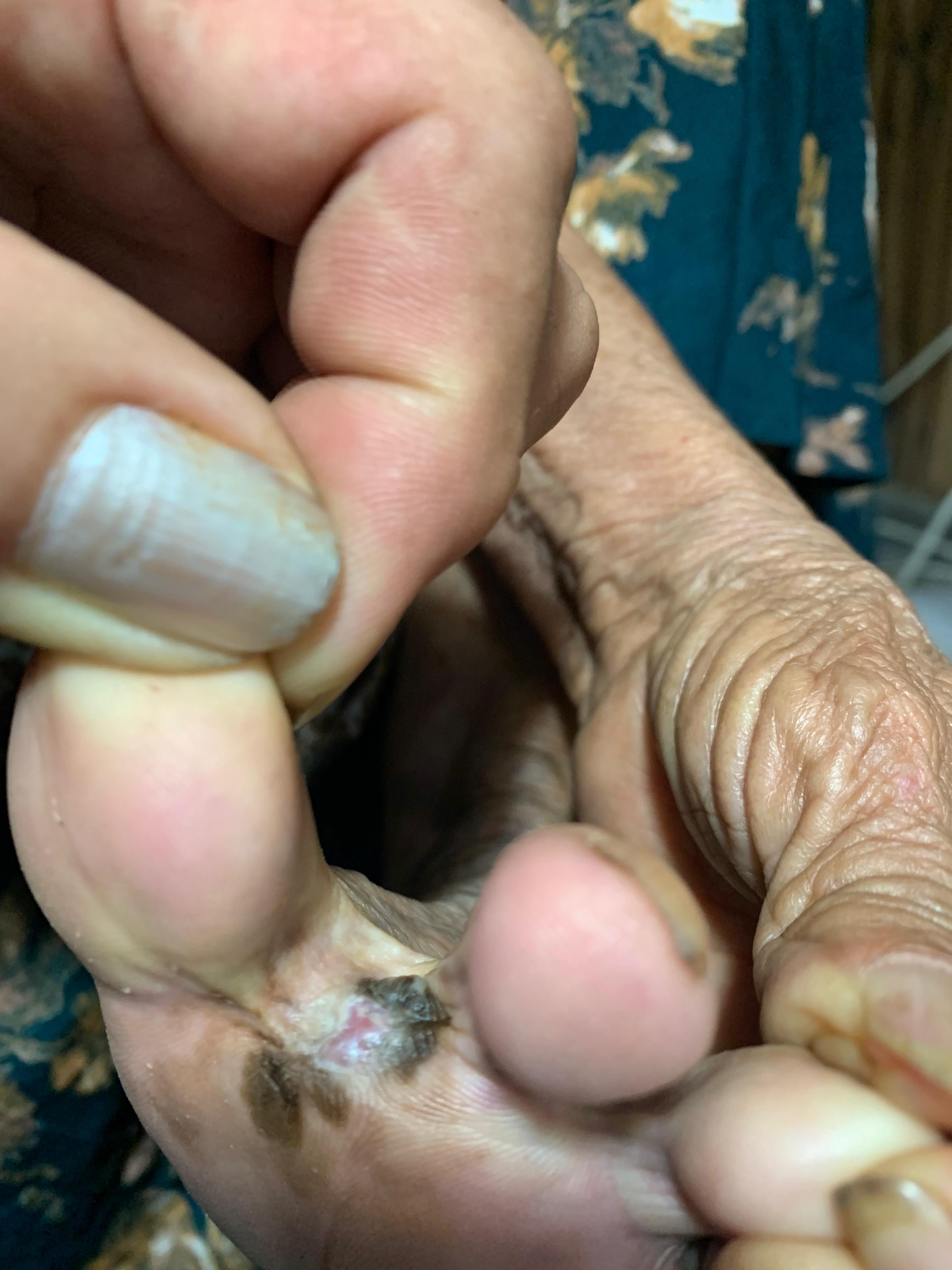 MELANOMA MALIGNO Acral interdigital