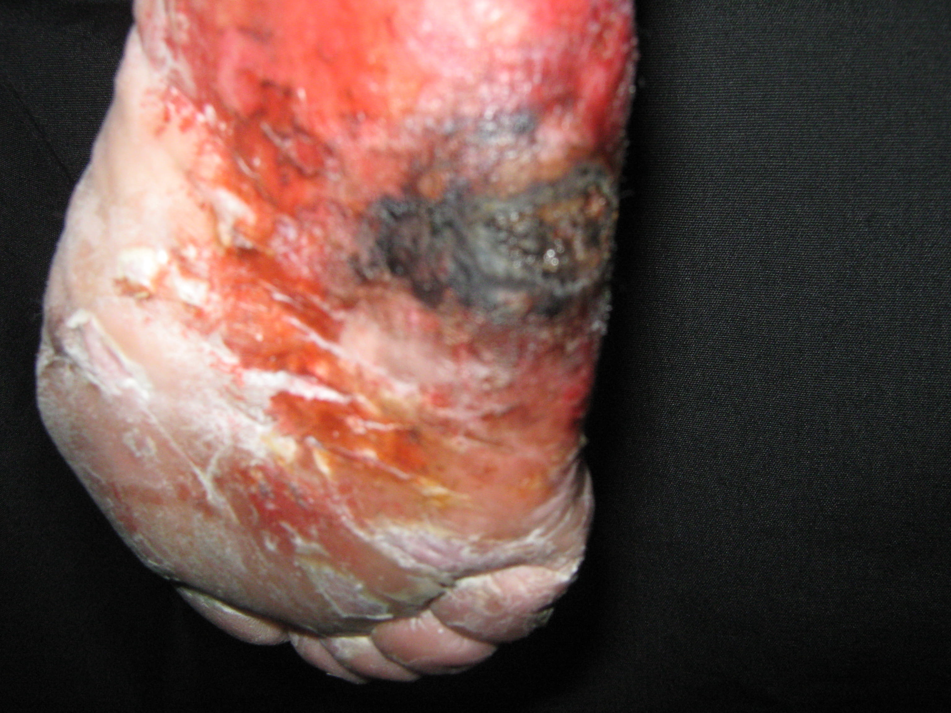 MELANOMA MALIGNO Acral pie derecho