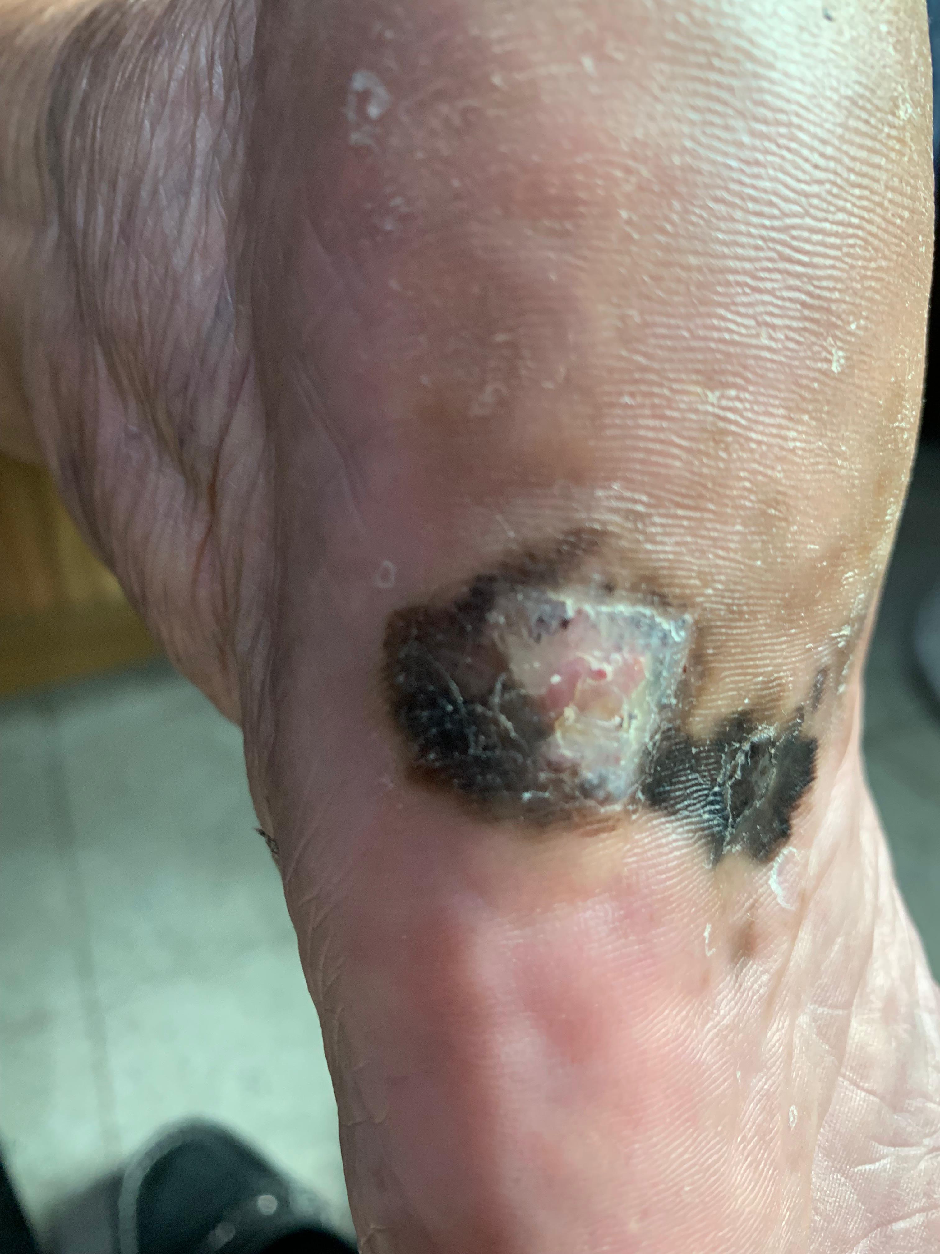 MELANOMA MALIGNO Acral pie izquierdo
