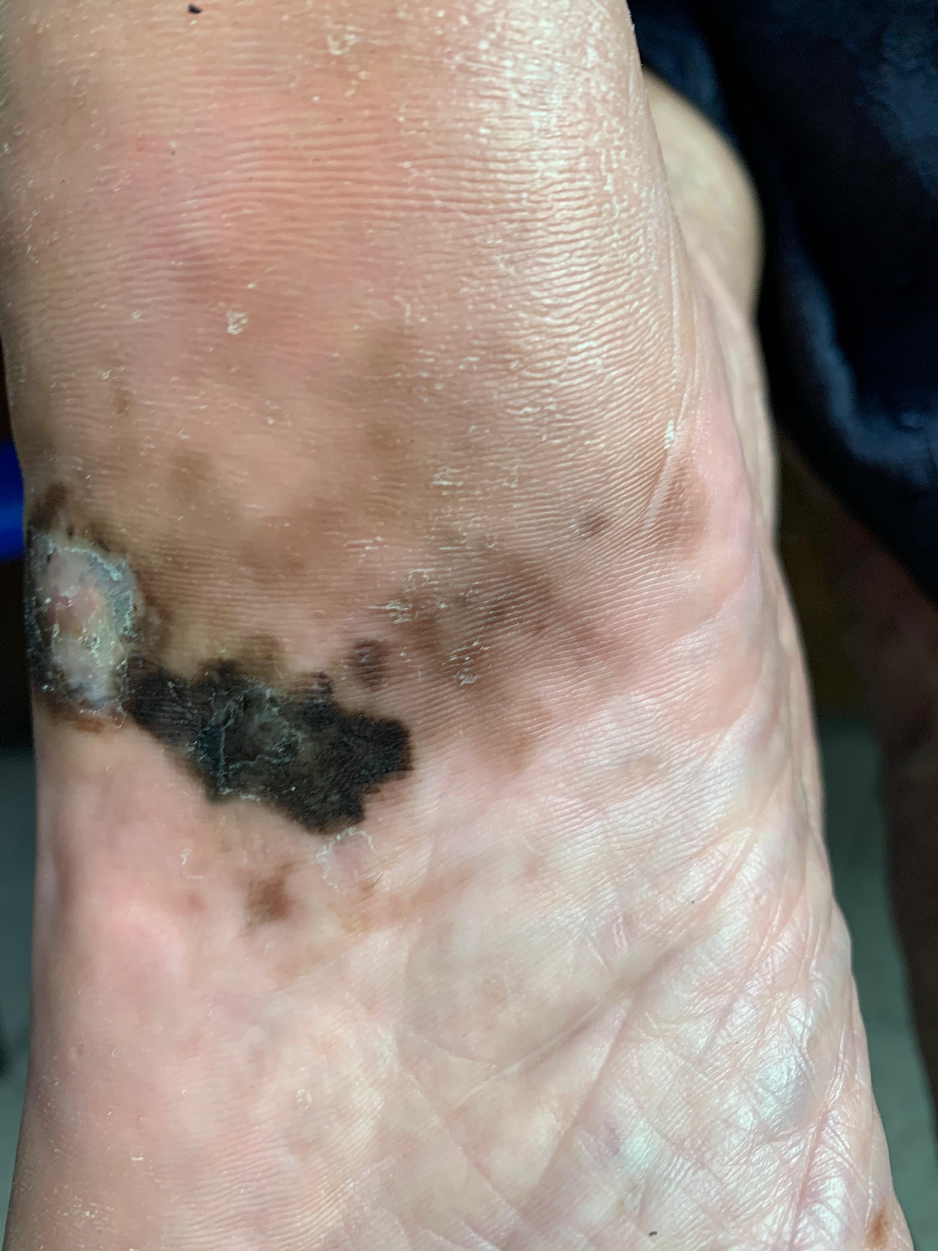 MELANOMA MALIGNO Acral pie izquierdo