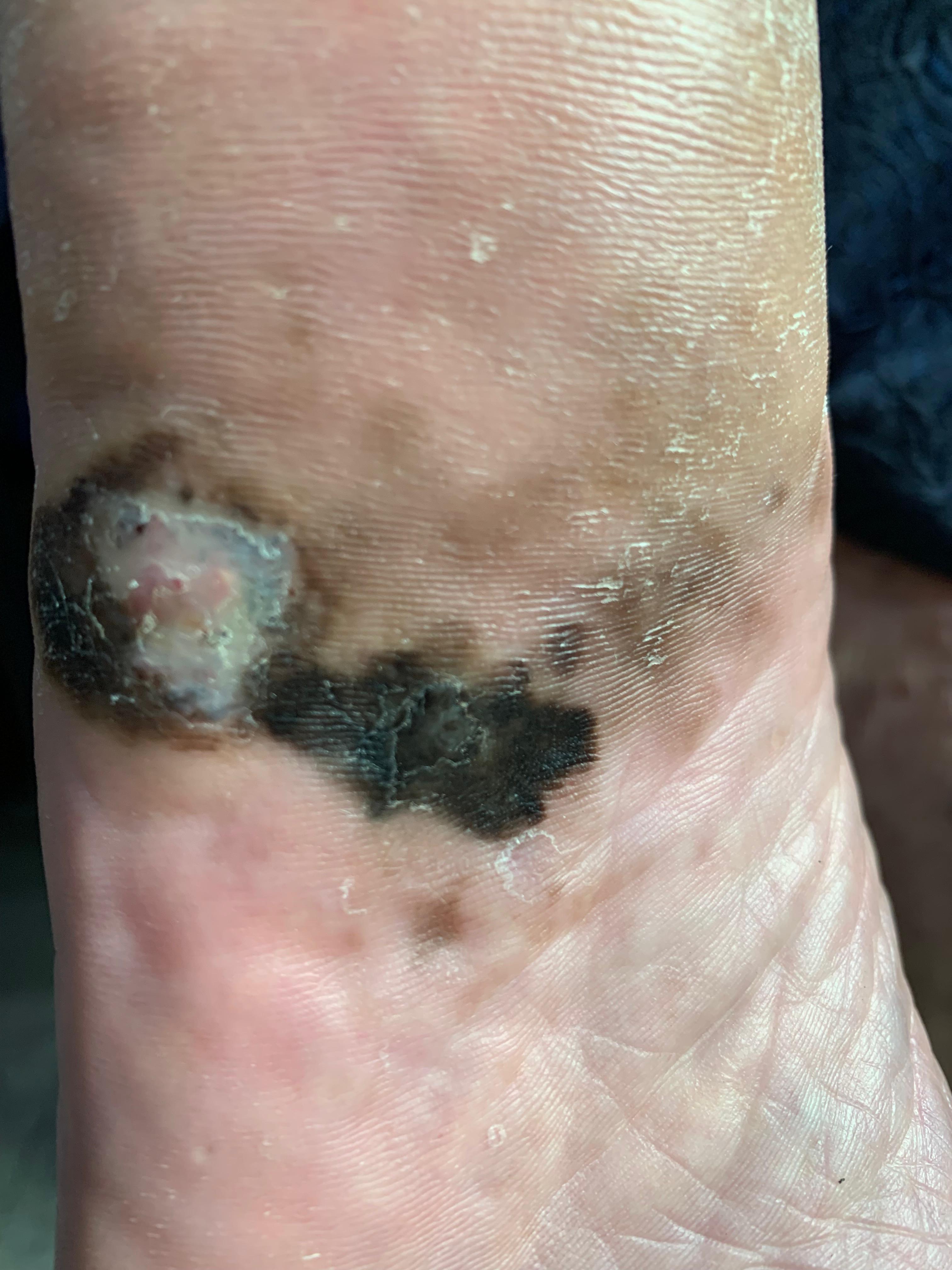 MELANOMA MALIGNO Acral pie izquierdo