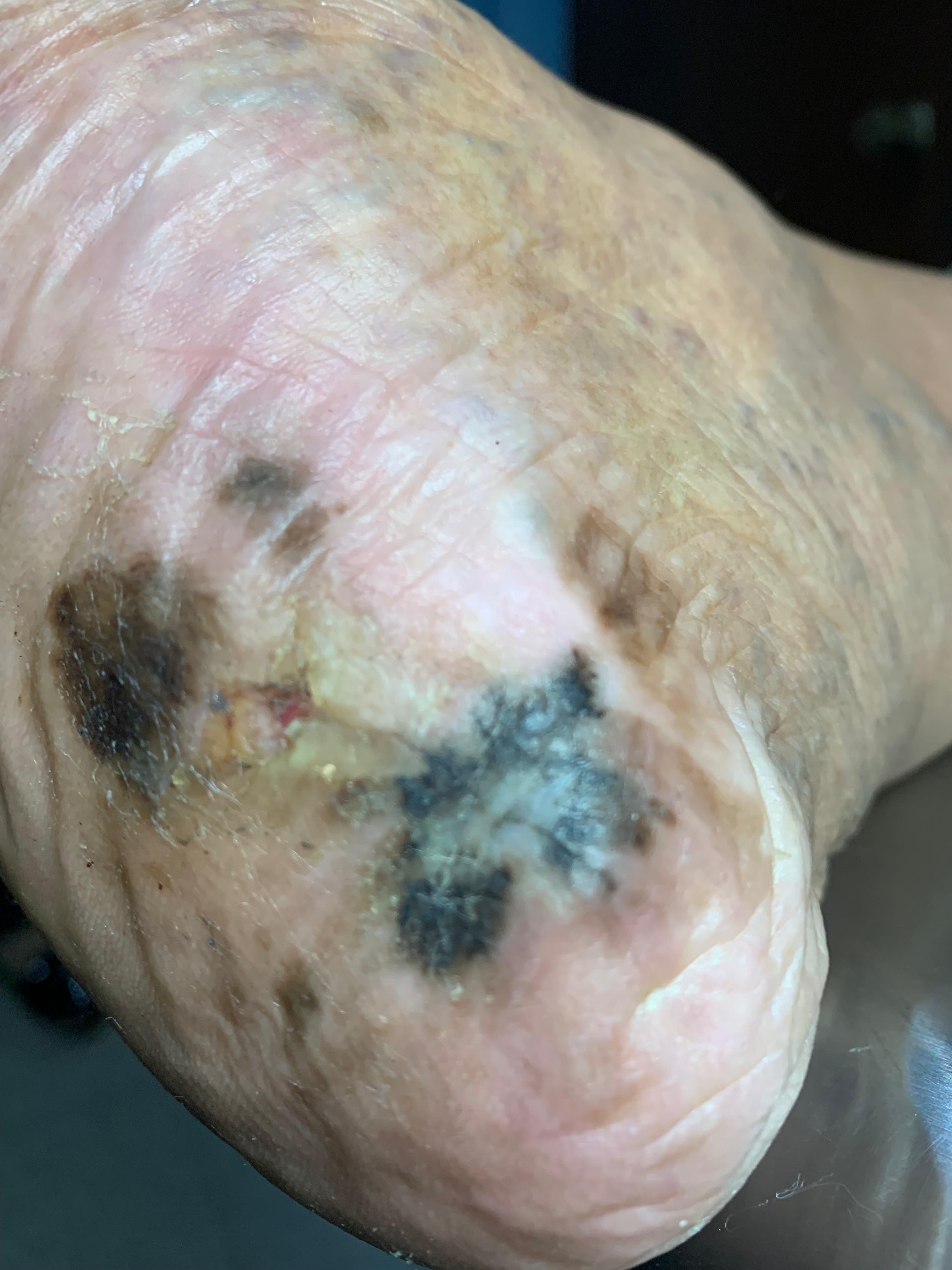 MELANOMA MALIGNO Acral del talón