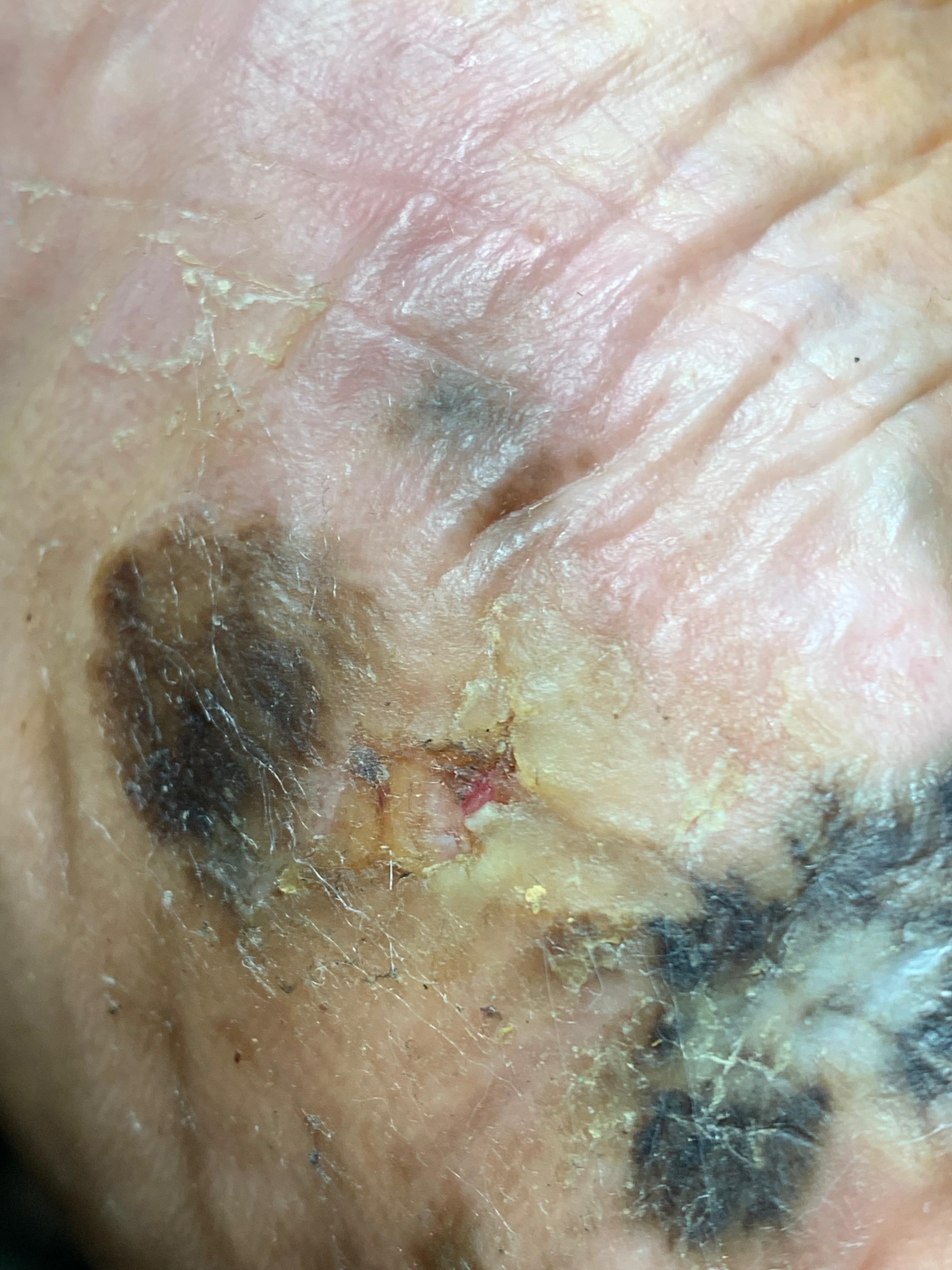 MELANOMA MALIGNO Acral del talón