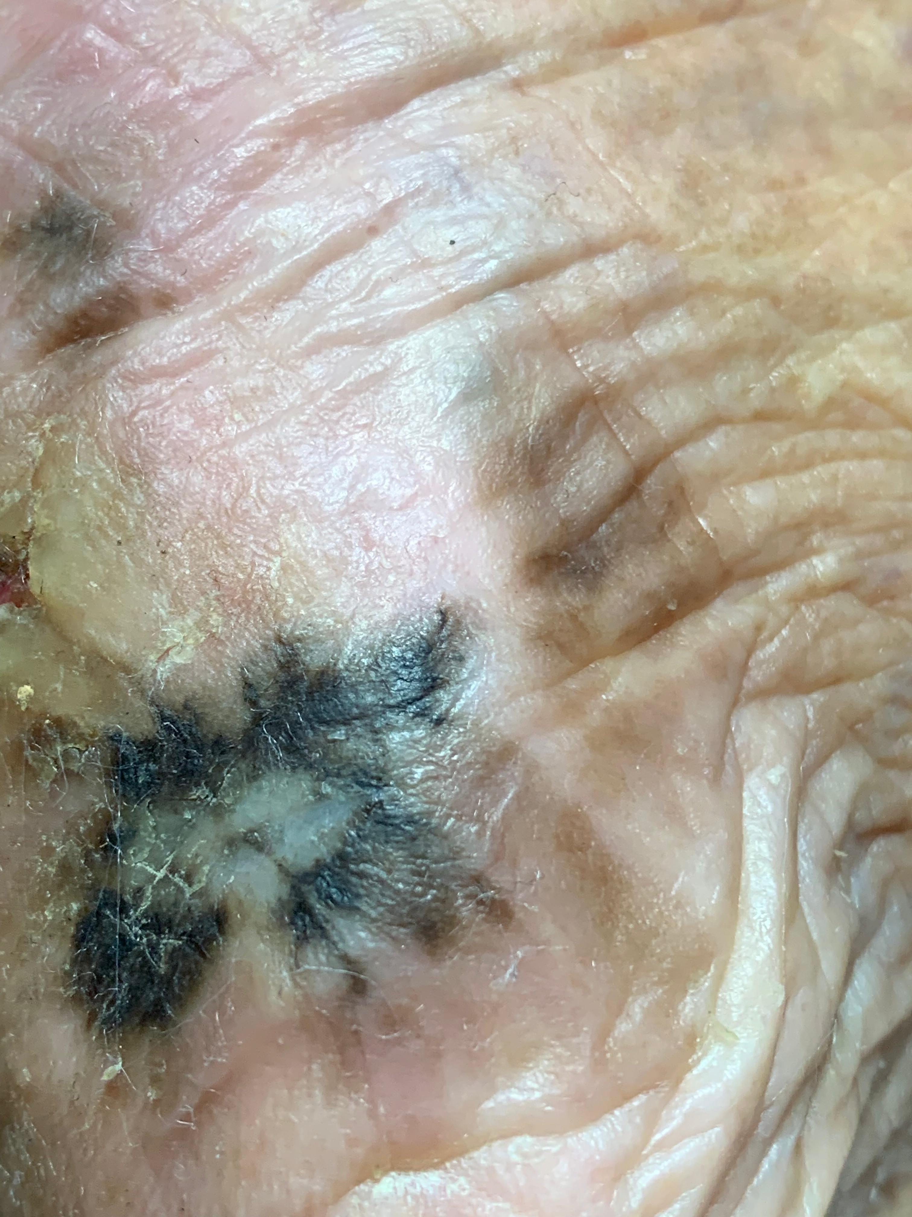 MELANOMA MALIGNO Acral del talón