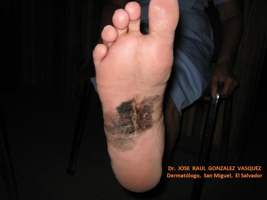 MELANOMA MALIGNO Acral pie derecho